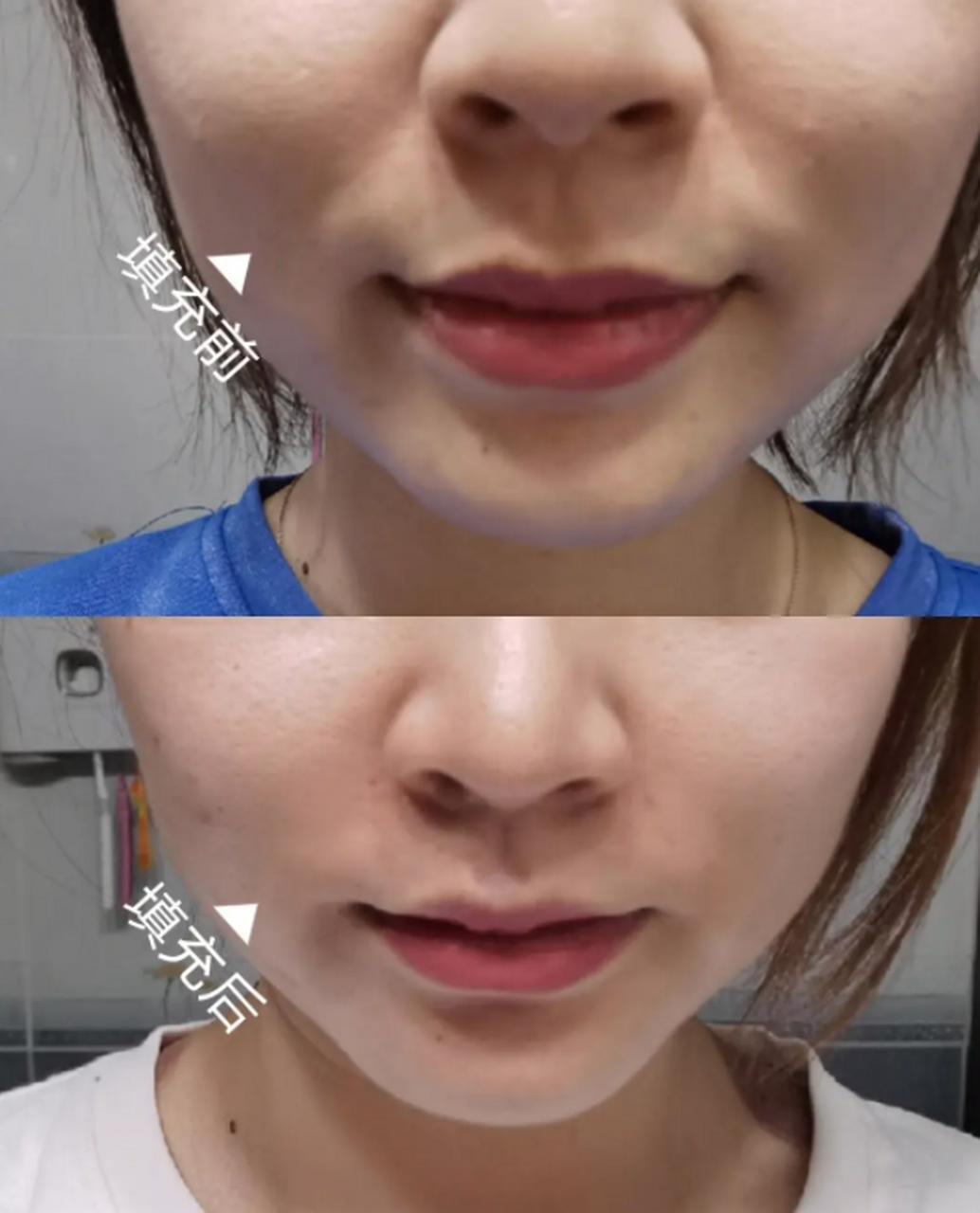 鼻唇沟深的改善方法   其实鼻唇沟和法令纹是一样的,就是叫法不同