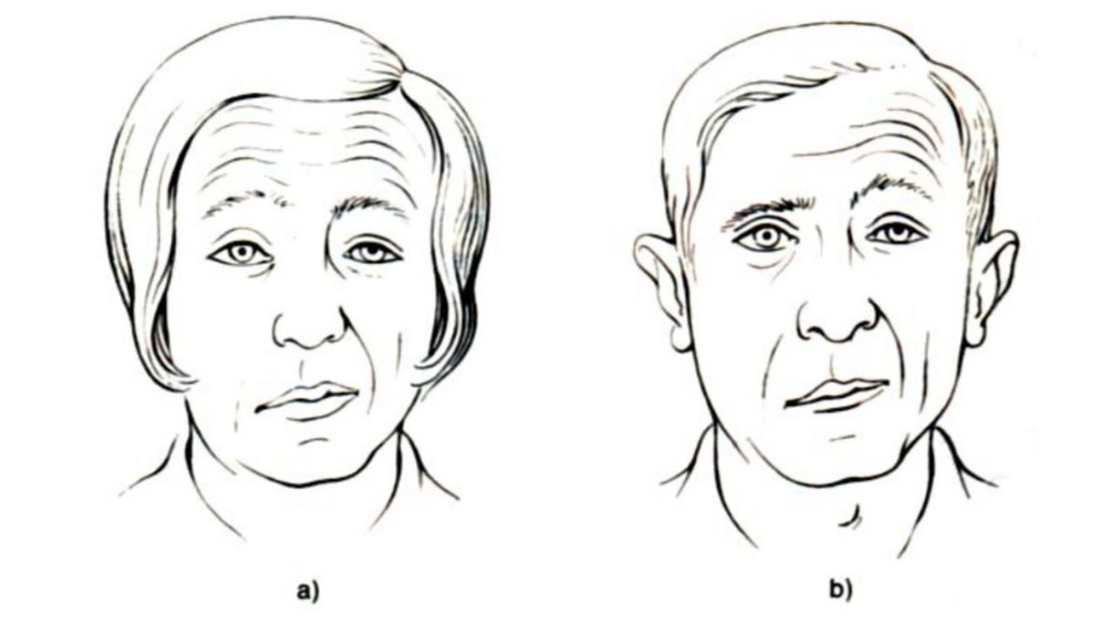 口眼歪斜,偏瘫,一个中药方加减改善  脑梗后遗症可能会出现偏瘫,口眼