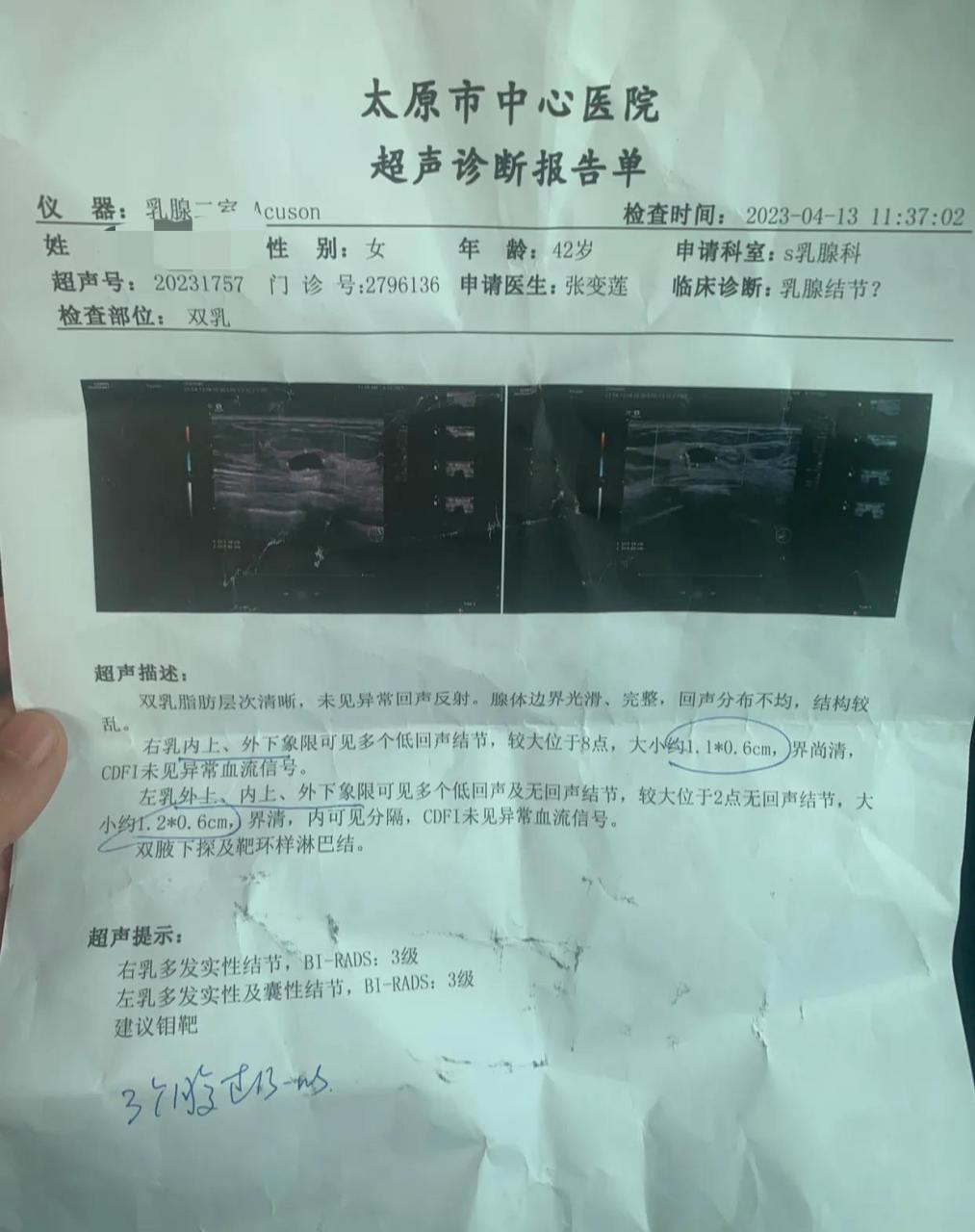 乳腺结节3类 终于做了个乳腺彩超 最近左乳间歇式疼 坚持了两周不见