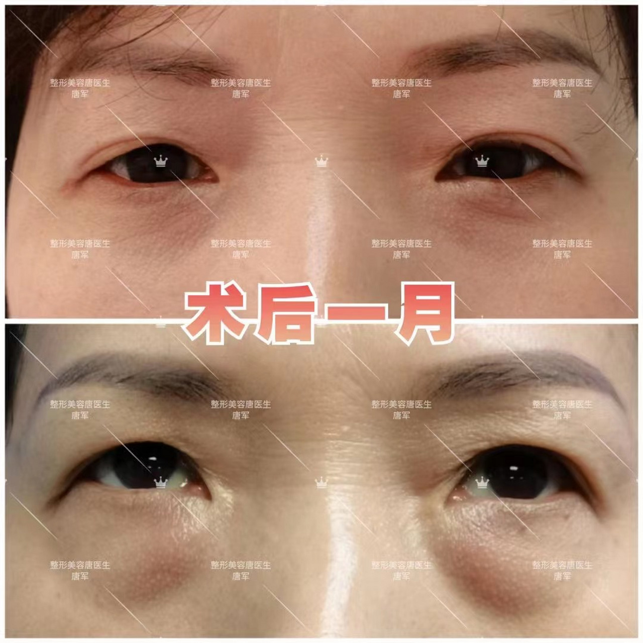 内切眼袋 术前:眼袋,泪沟明显 术后一月:基本完全消肿 #眼袋# #泪沟