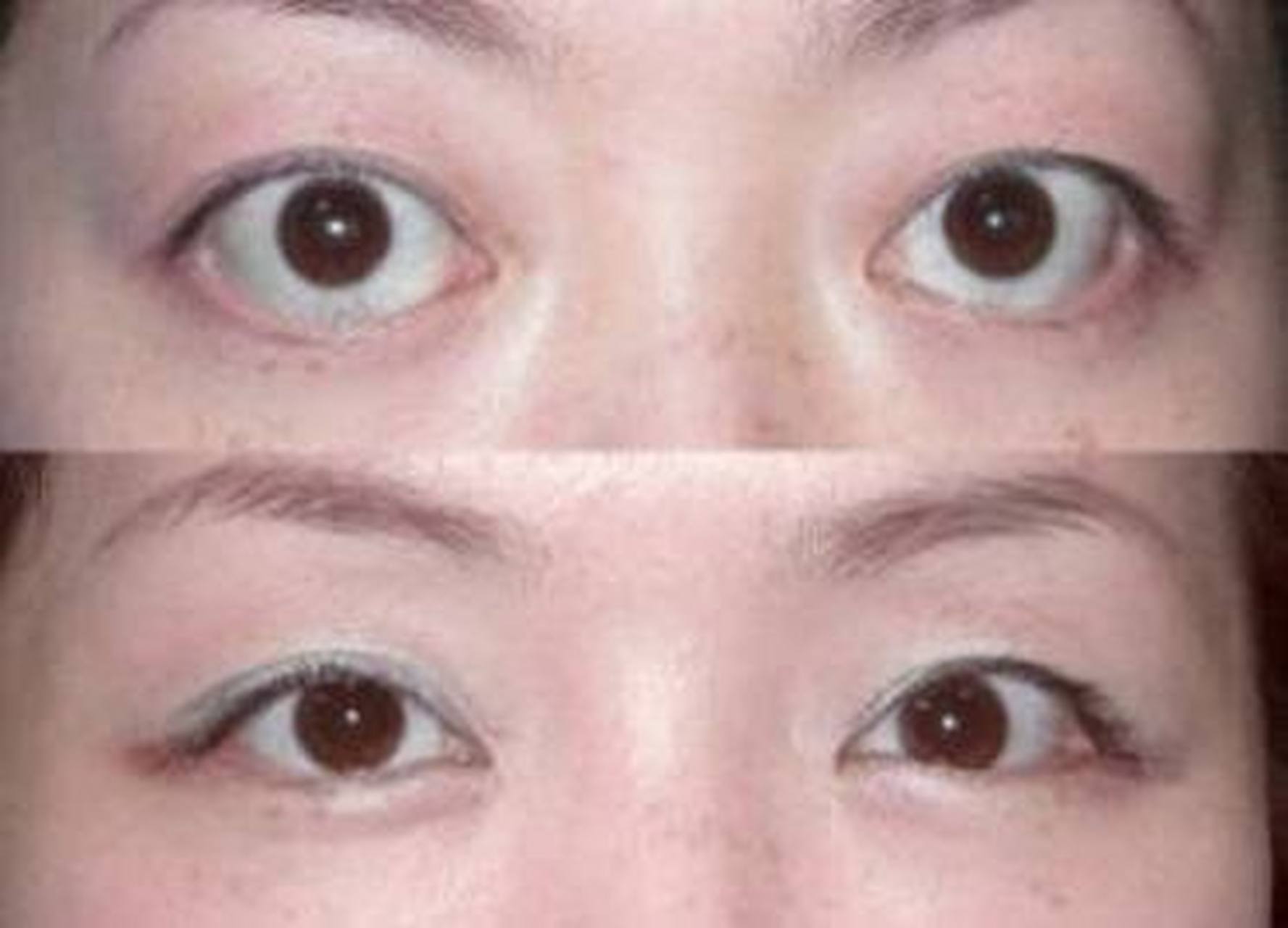 甲亢表现为:眼凸,面色潮红,脖子粗,饭量大体重减少,心率加速,多汗怕热