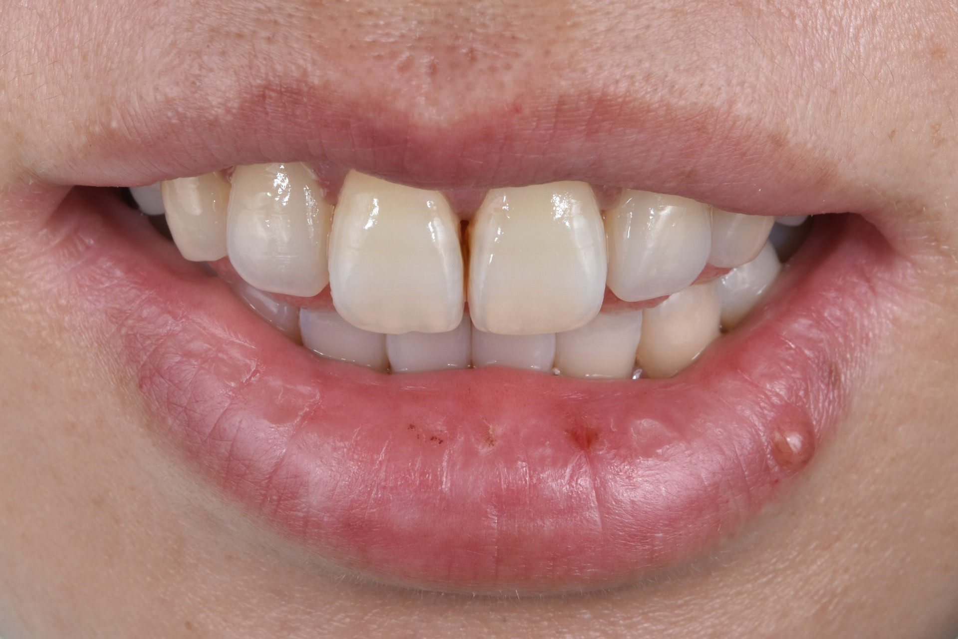 扬州仪征的聂女士自觉门牙有缝,发黑,不够美观,来我院就诊.