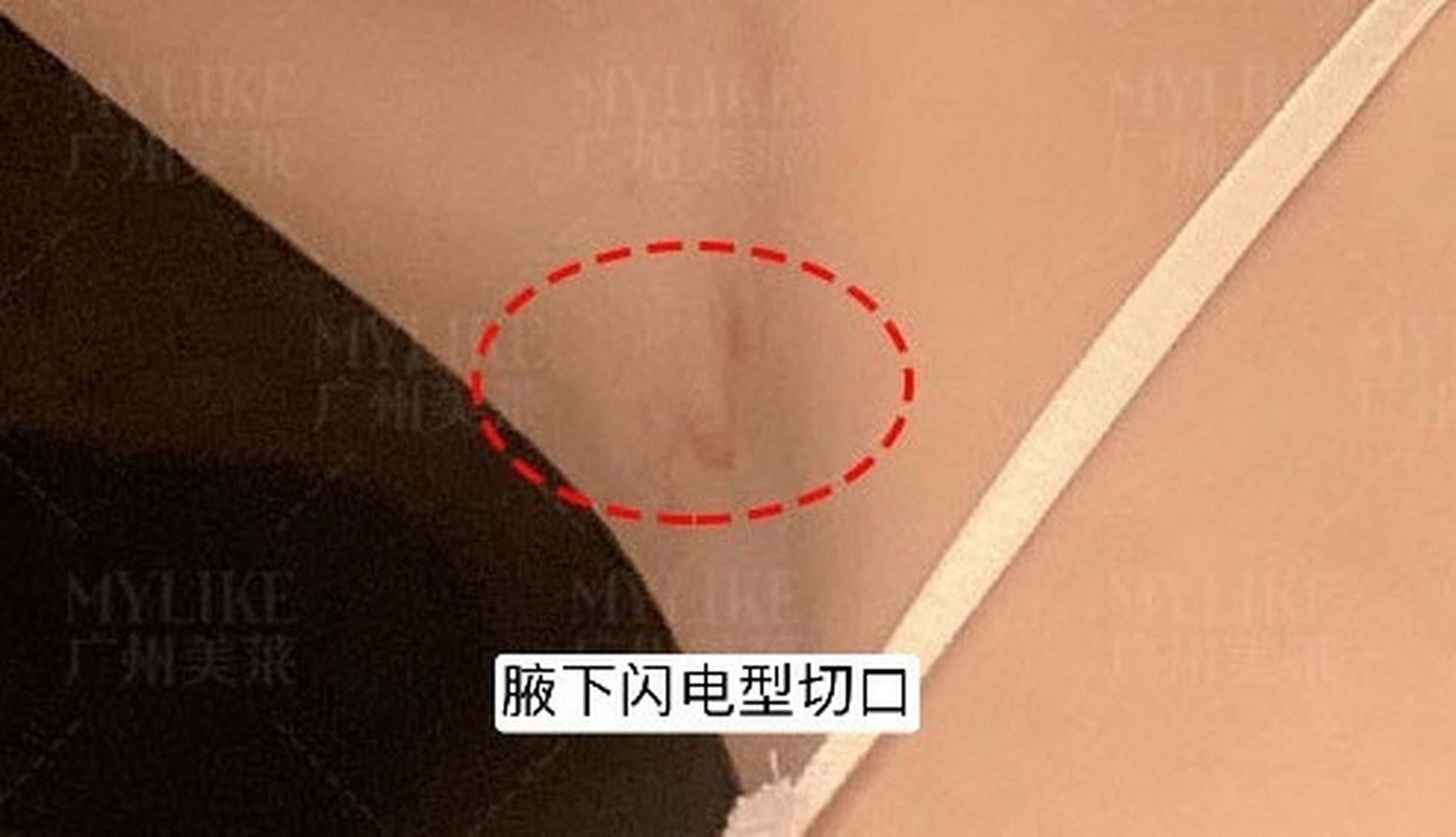 假体隆胸三种切口方式怎么选最好?