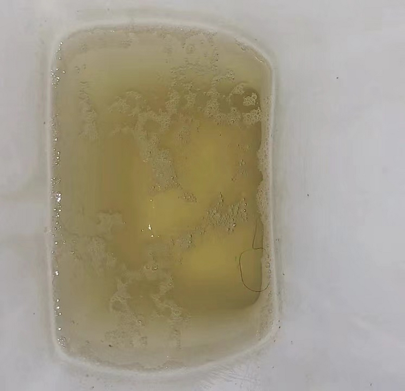 近年来,肾病患者对尿蛋白转阴后尿液中仍有泡沫的现象产生了广泛关注.