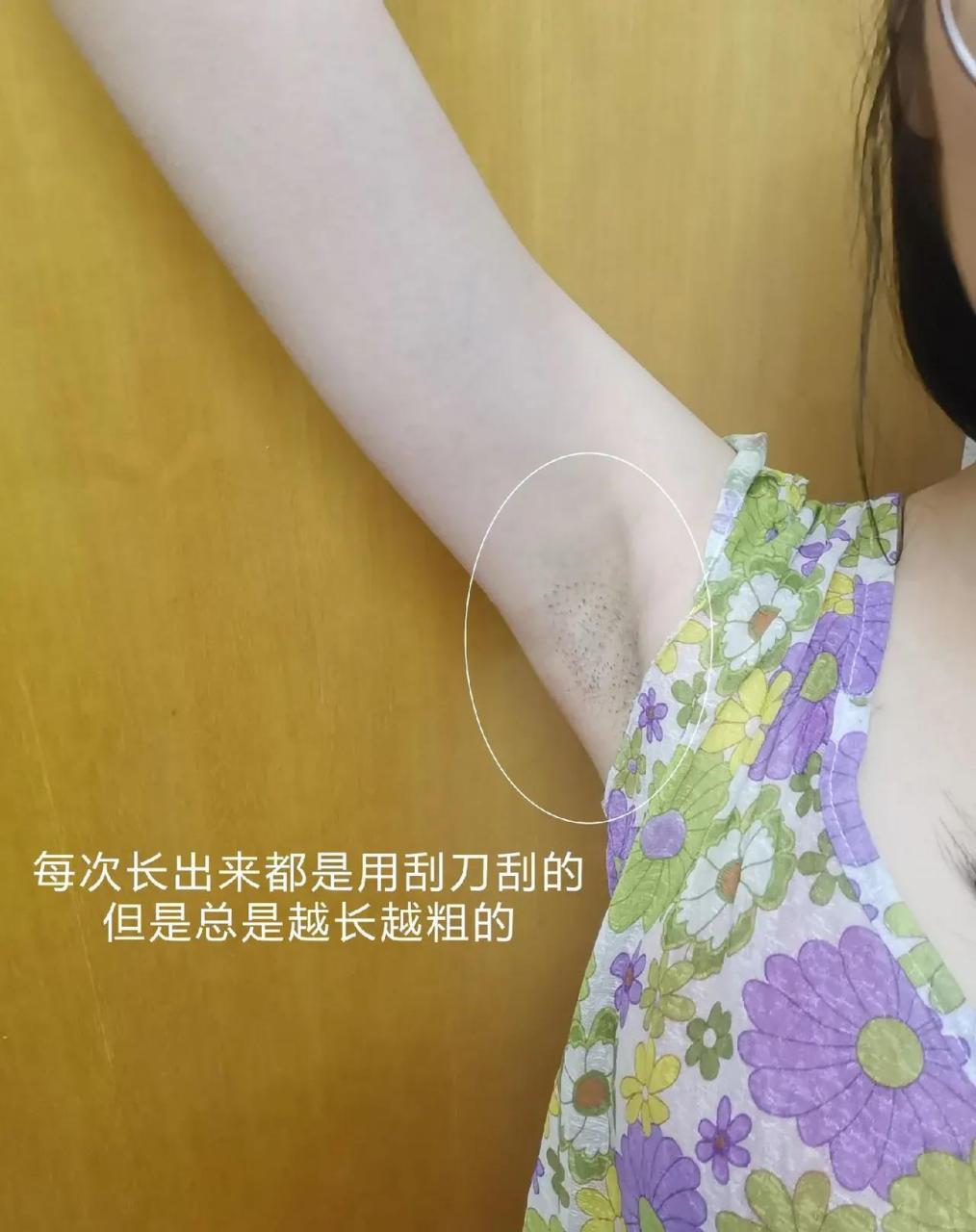 女性腋下为什么会长毛毛?可以刮掉吗?能用脱毛膏吗?