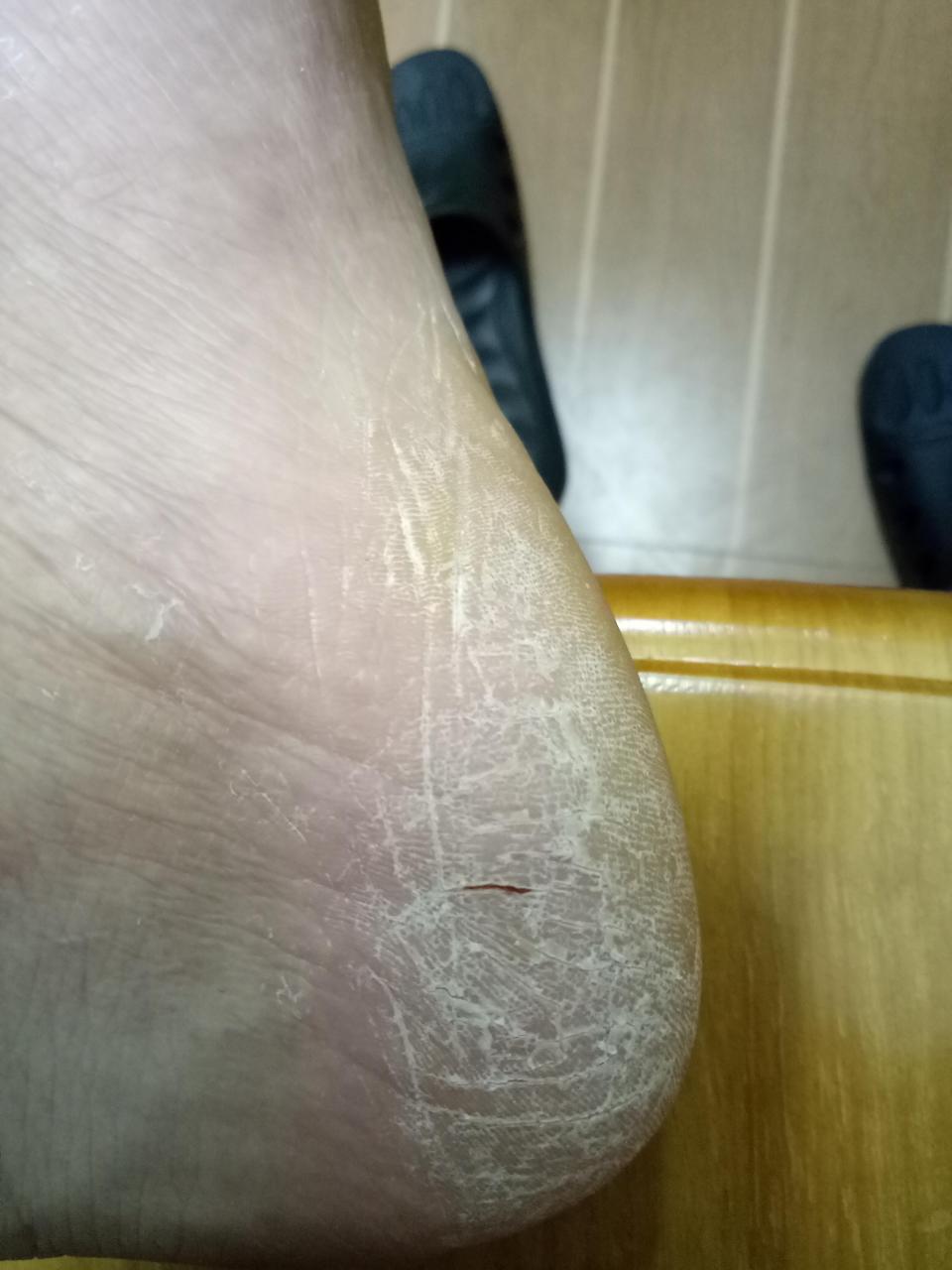 脚后跟侧面起硬皮干裂,怎么回事?