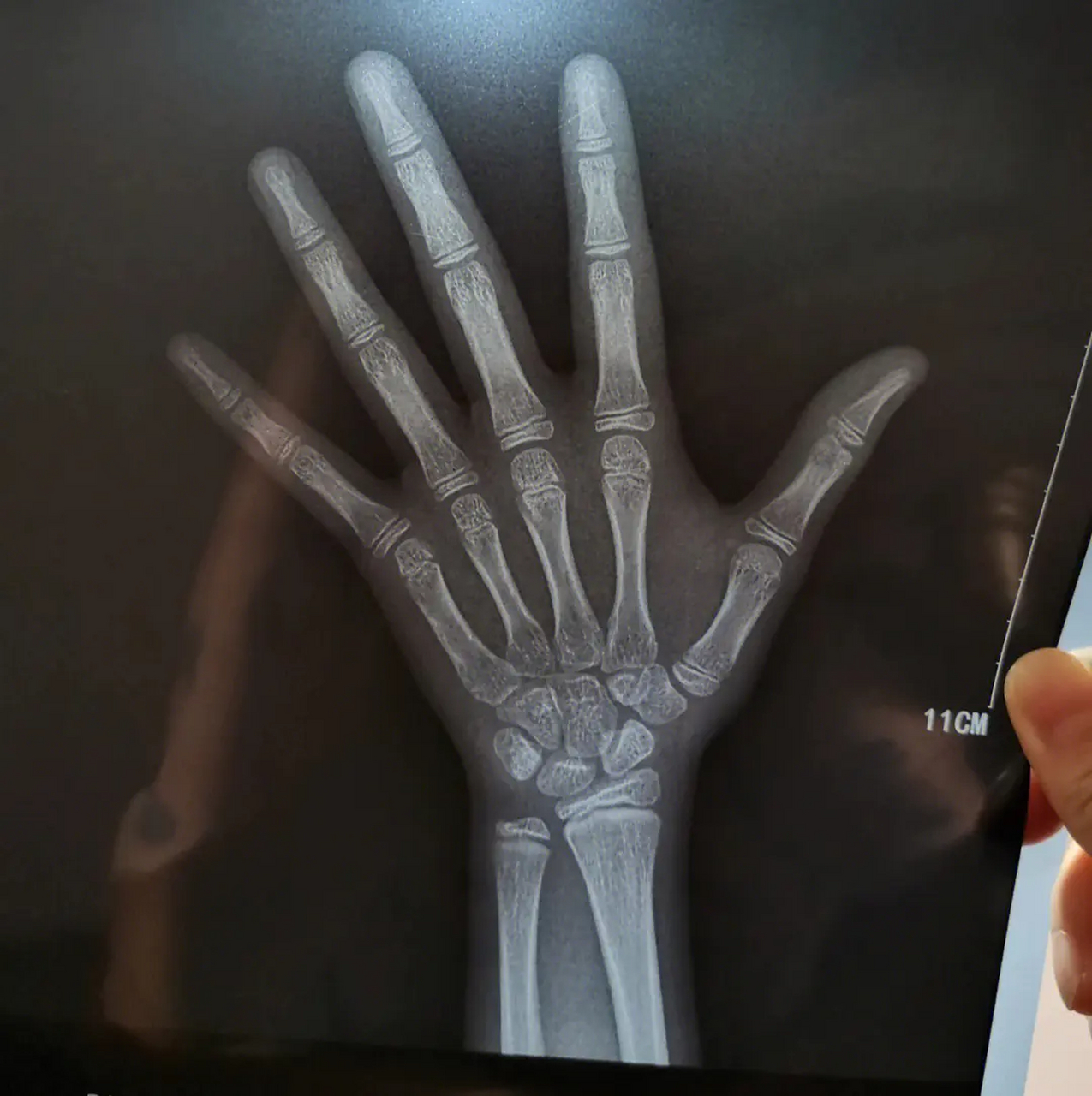 10岁女孩,身高150公分,骨龄11岁半,一直在学民族舞,遗传身高162