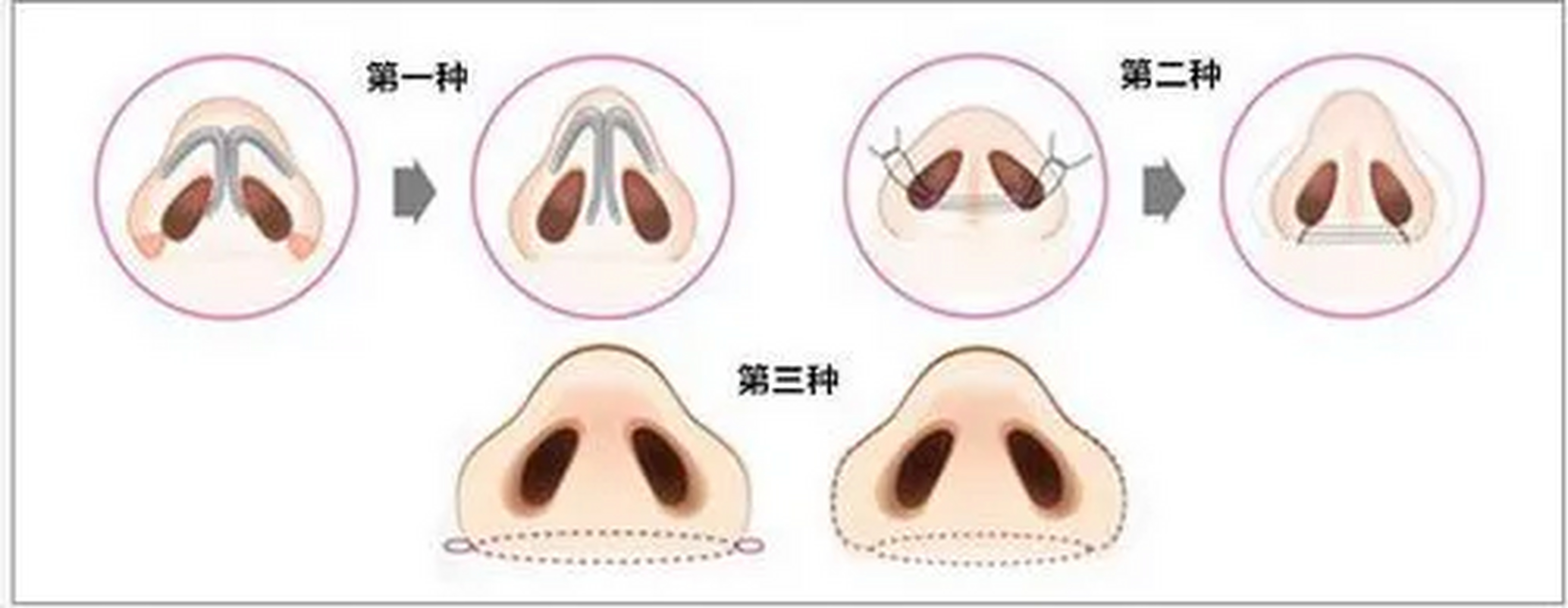 做鼻功課的小仙女都知道鼻翼肥大會影響我們鼻子正面的美觀,這種時候