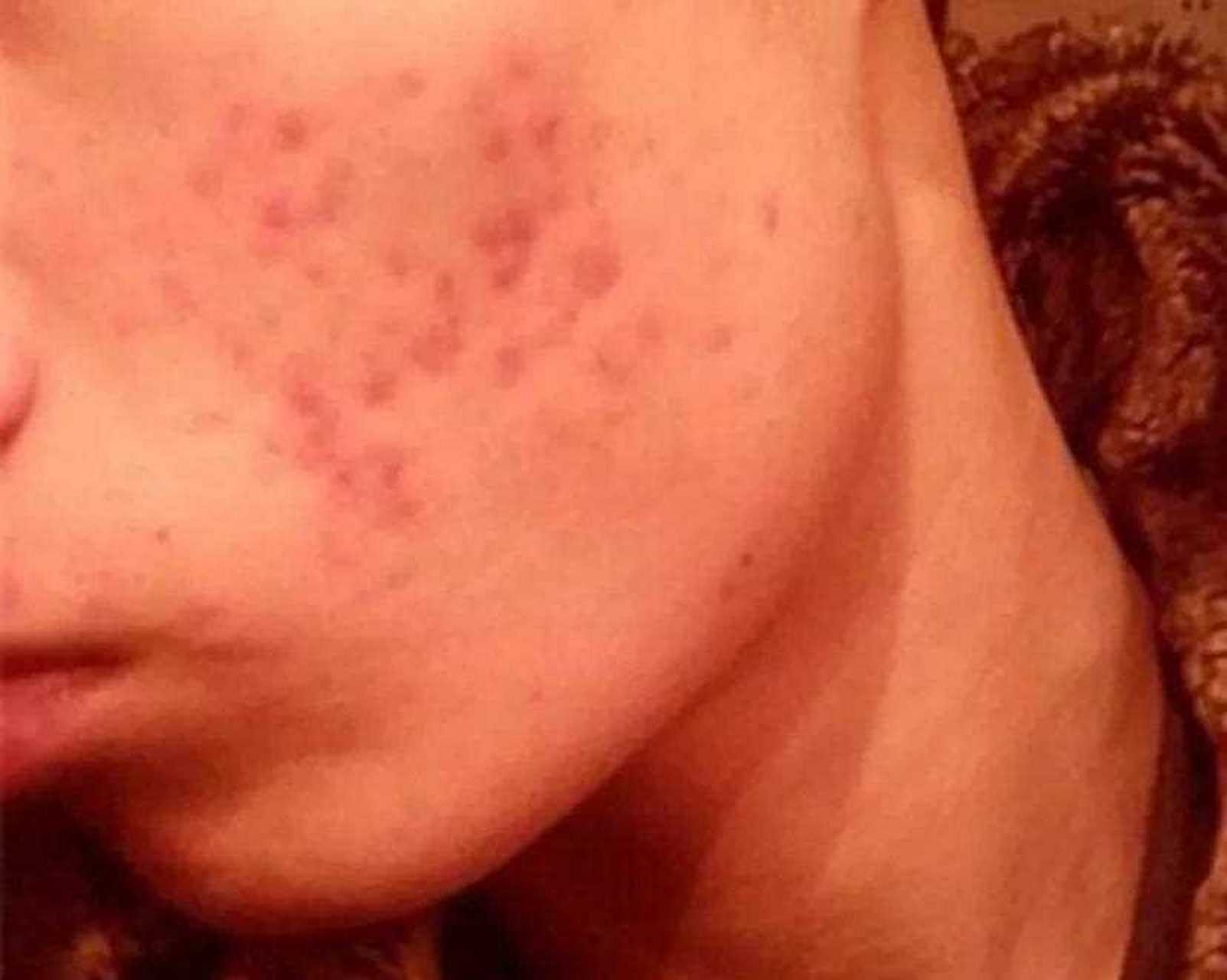 为什么痘痘都是红色的为什么在线