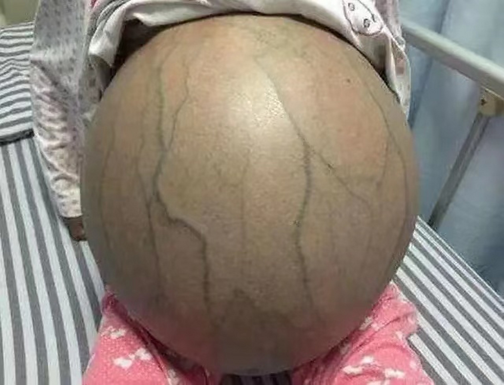 肝硬化腹水抽了就好了吗?