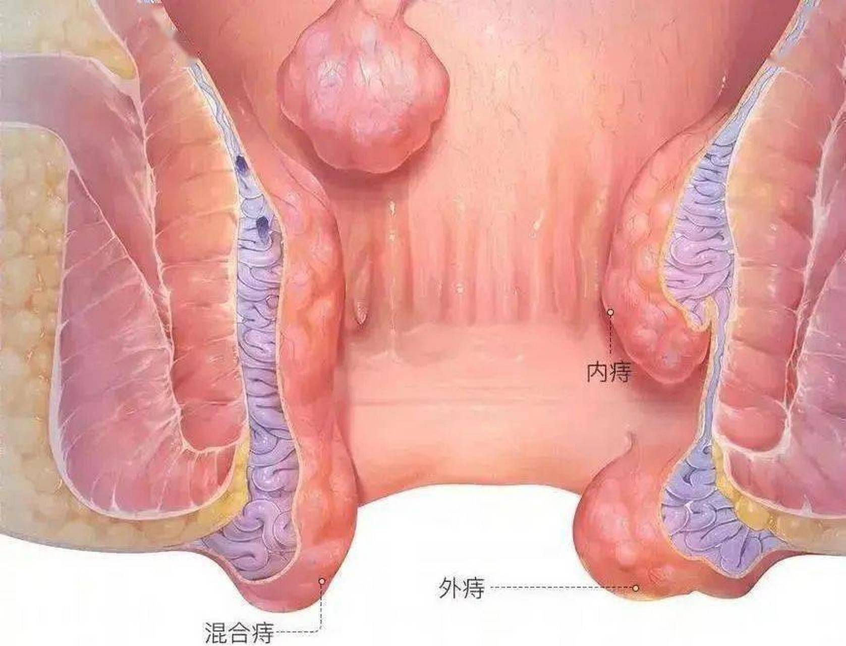 也不敢去检查,不知道该怎么办"  很多人在初次发现肛门处的肉球后都会