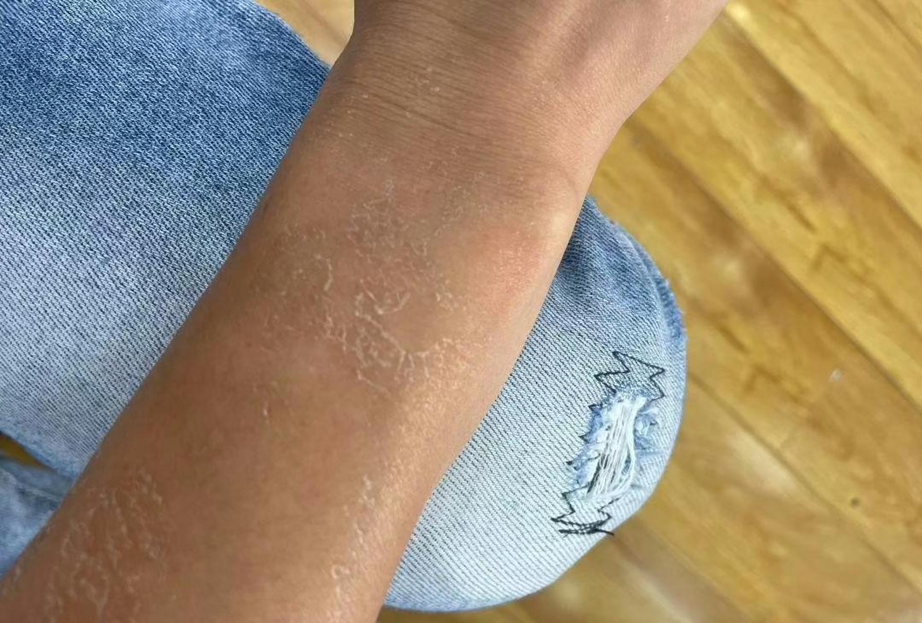 一到冬天皮肤就开裂,怎么办?