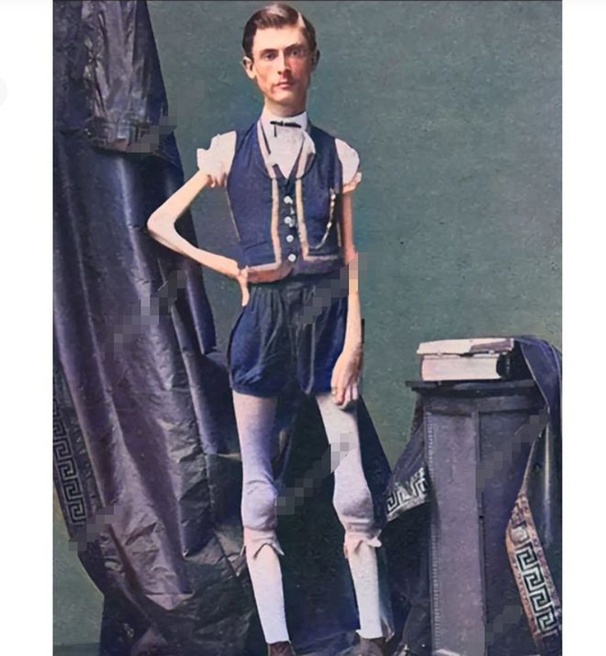 1866年,一名男子因罹患奇怪的疾病而备受关注.