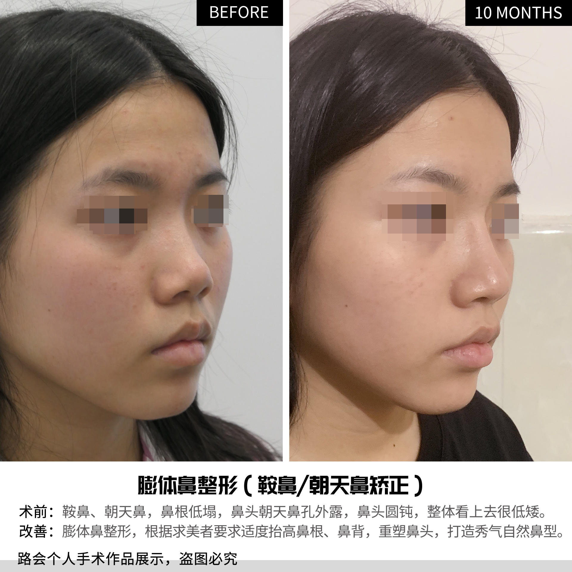 鞍鼻就是俗称的低鼻,鼻背山根非常的低,无论是正面