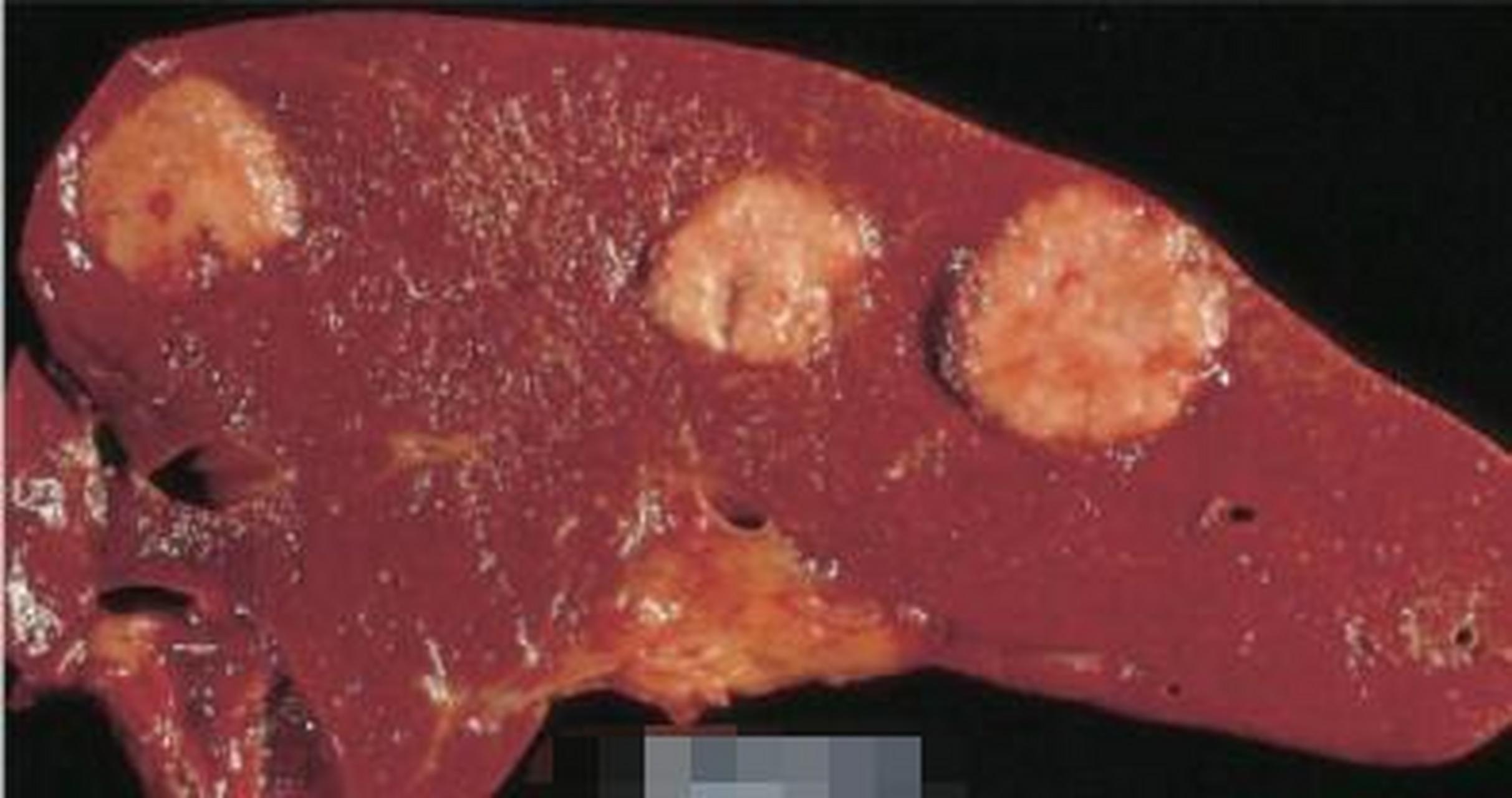 癌症在肝脏的转移灶,最麻烦的是,开始转移,肝脏根本无感知,只有等肝脏