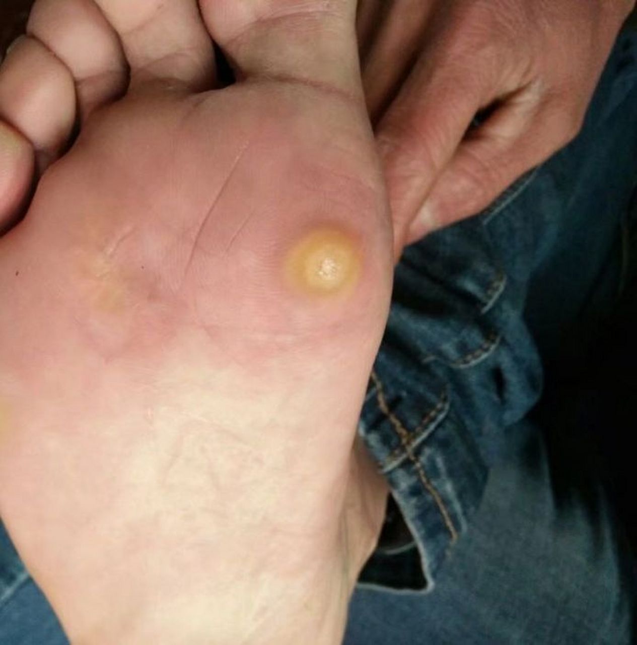 鸡眼是由于患者的皮肤长期受挤压和摩擦刺激,导致角质锥形增生形成的