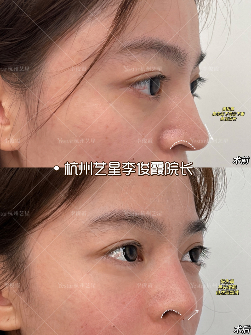 鹰钩鼻矫正 术前鼻尖向下弯曲下垂,鼻宽而长术后鼻尖挺翘,自然海鸥线