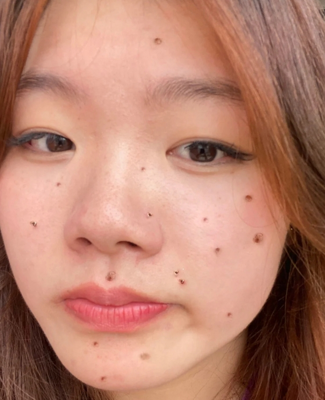 点痣留下的黑色印子可能会给人带来烦恼和不安,因此许多人希望找到