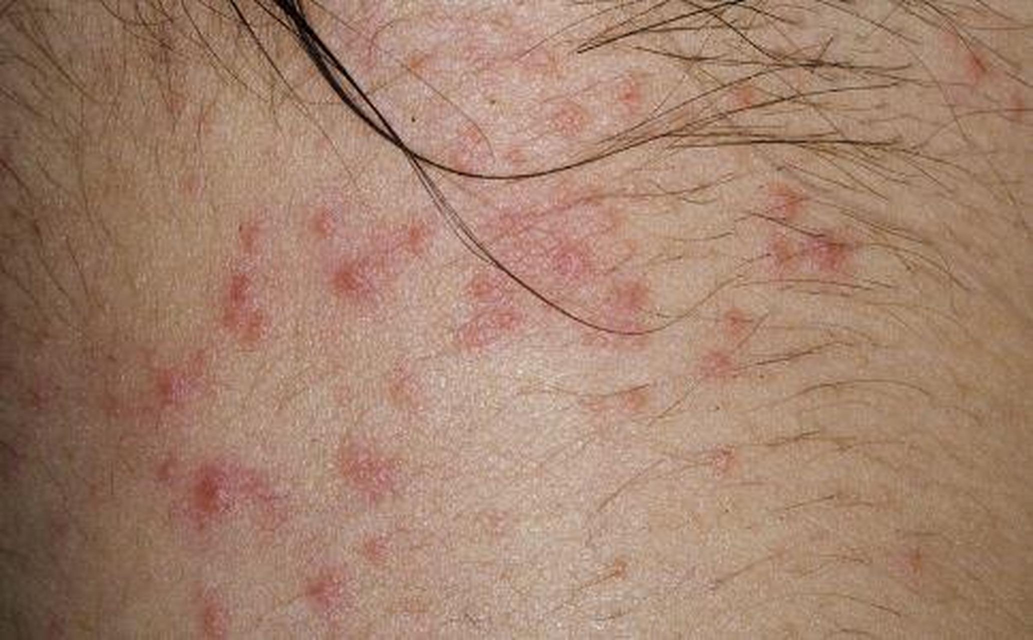 皮疹颜色鲜红,皮肤伴有肿胀,糜烂渗出,起水泡,渗黄水等症状表现