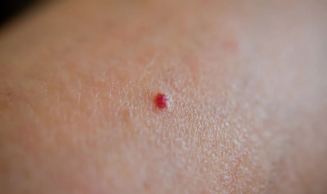 血管痣有两种,血管瘤和血管畸形.