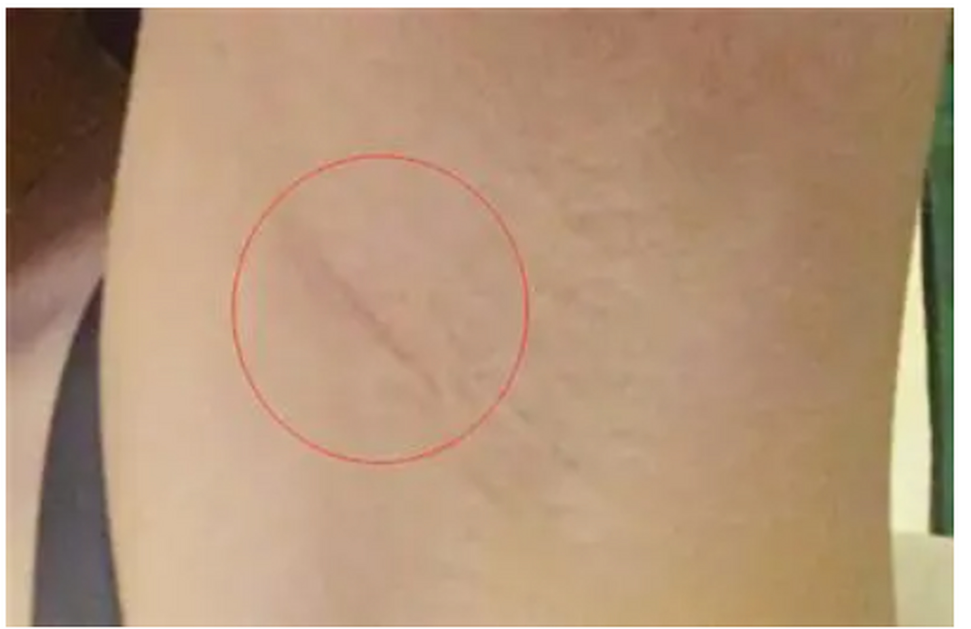 隆胸后会有明显疤痕?  是手术就会有创伤,留下疤痕是不可避免的.