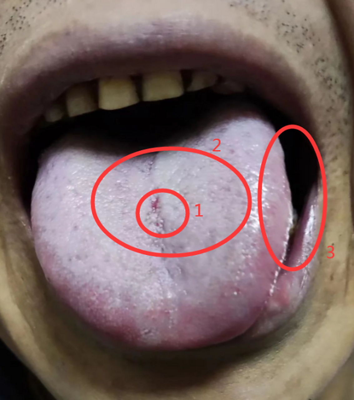 【每日舌诊:阴囊冷痛,潮湿,虚劳,脾胃寒湿】02  这是一位46岁男同志