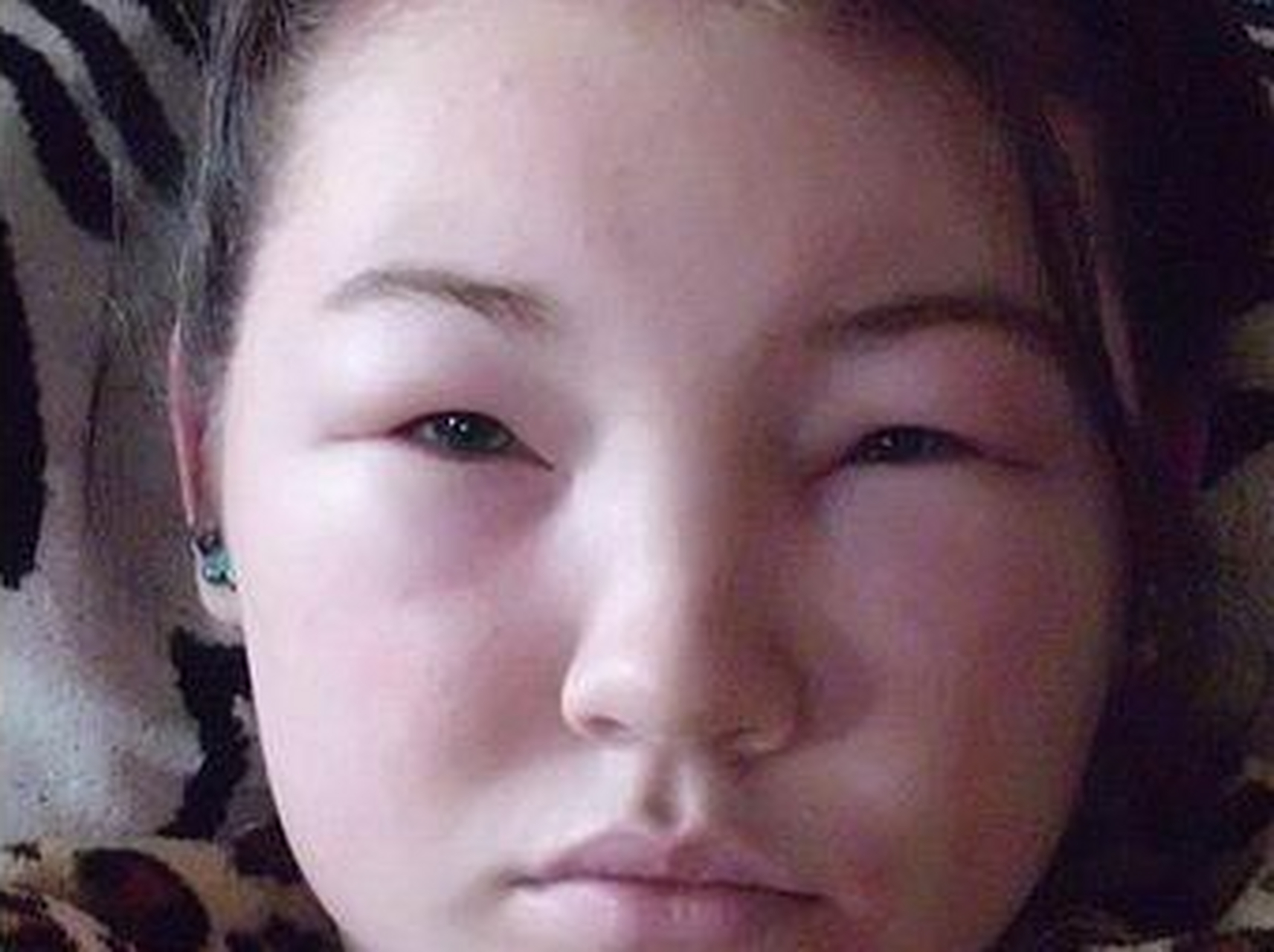 糖尿病肾病,这时候肾小球损伤,大量的蛋白从基底膜漏出,血液当中的