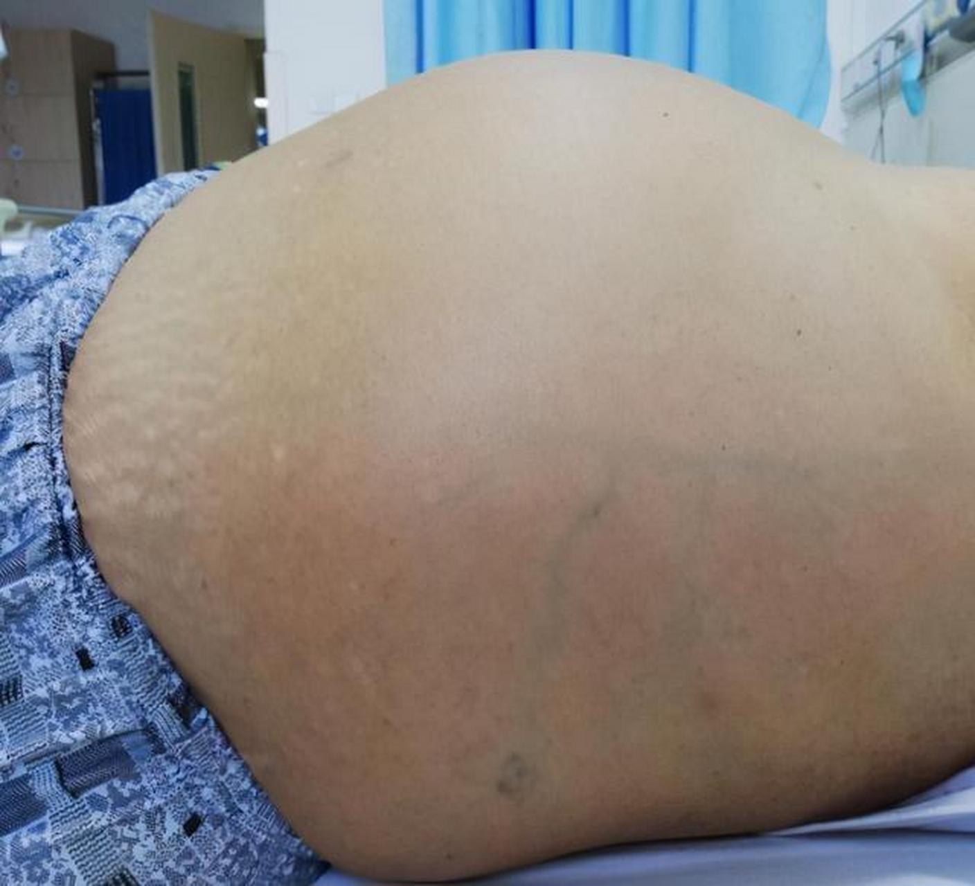 肝腹水,尤其是顽固性肝腹水,是很严重的,死亡率很高,1年死亡率可以