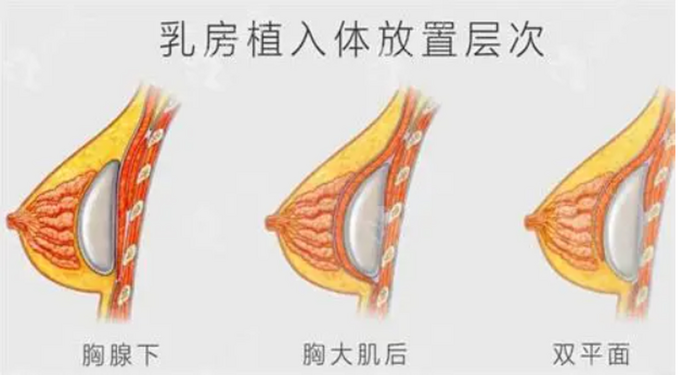 双平面隆胸手术的优点是:它综合了乳腺后和胸大肌后两者的优点,同时也