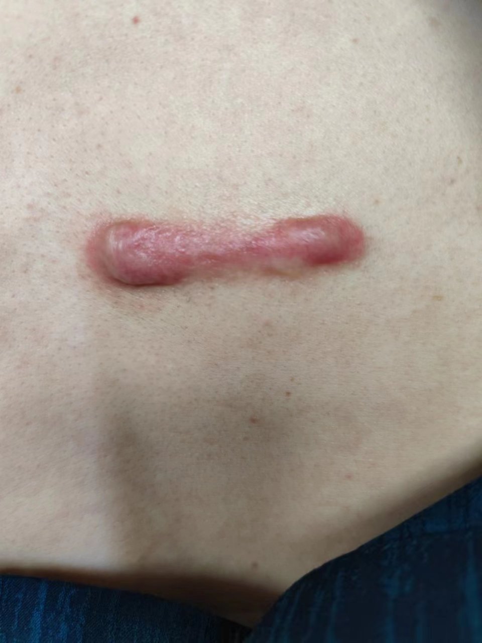 你为什么长疤痕疙瘩,你知道吗?