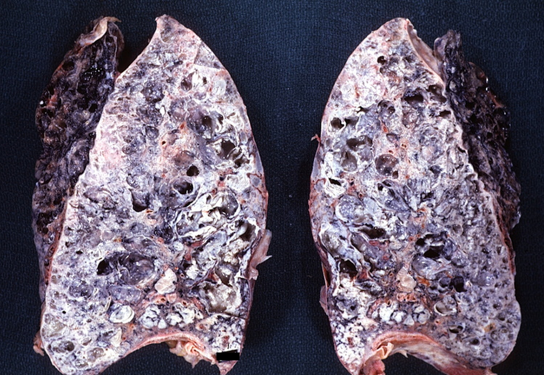 少部分不可逆转的肺纤维化,主要是肺间质纤维化,不过,肺间质纤维化