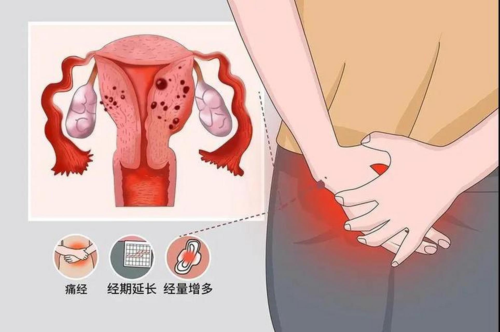 腺肌症# #上海看子宫腺肌症的医院哪家好# #上海妇科医院哪家比较