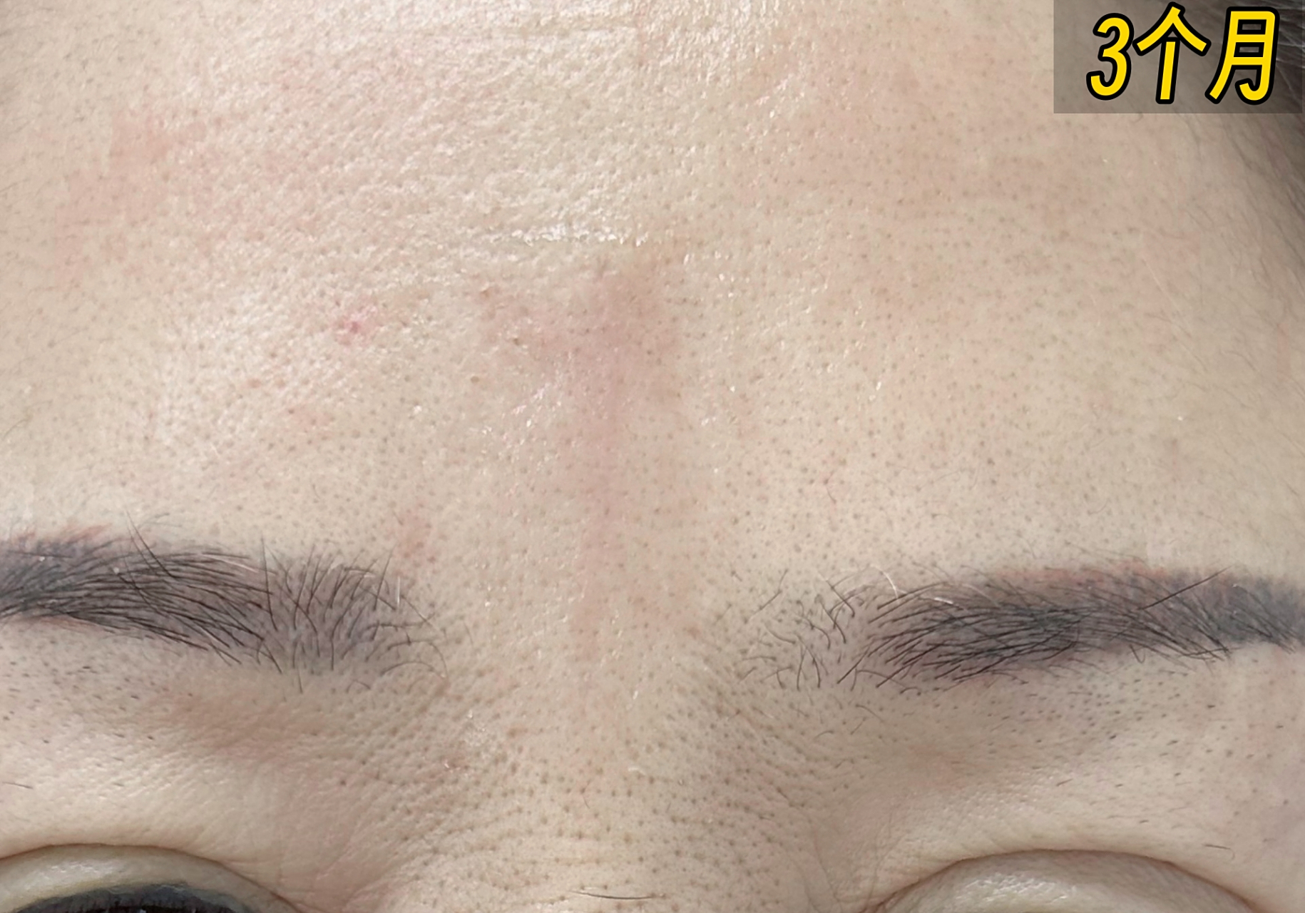 印堂悬针纹是指眉毛正中央的位置出现微小的凹陷或纹路.