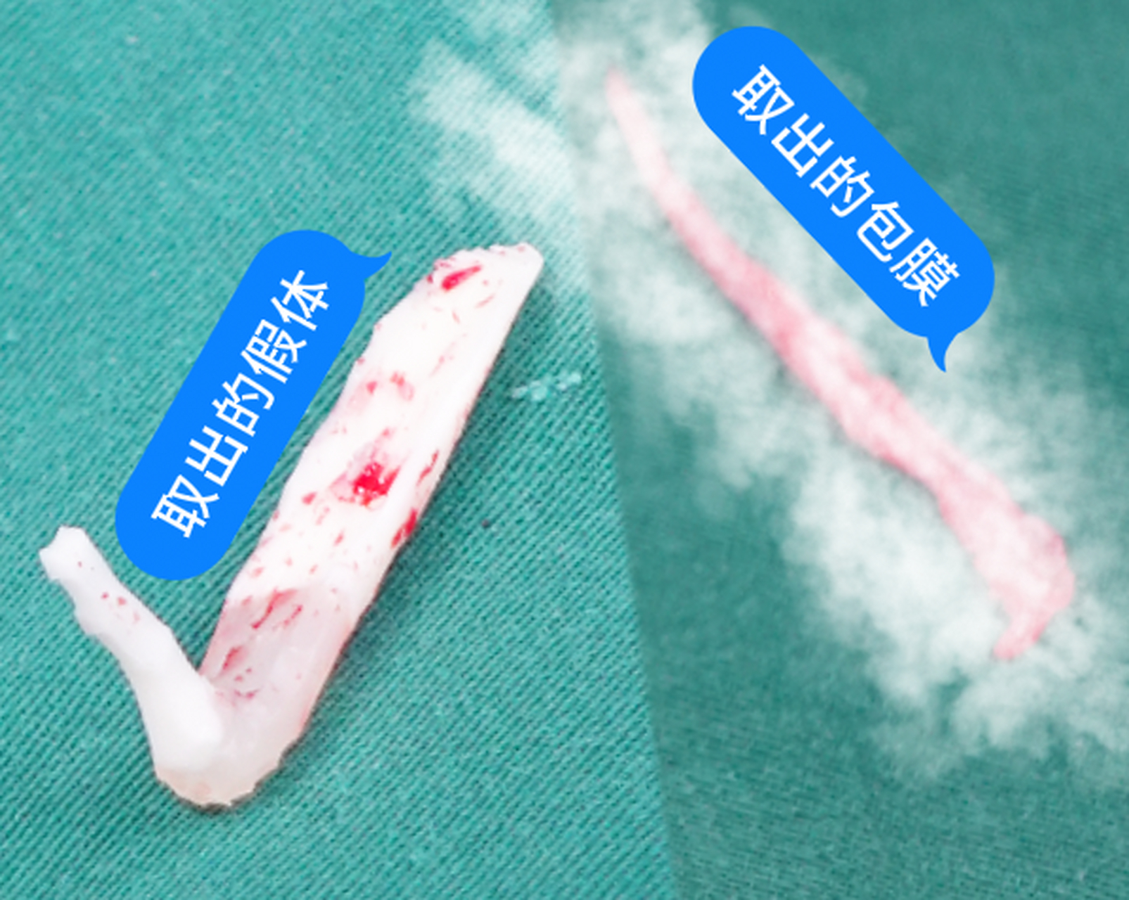 这个求美者十几年前做过两次鼻子,现在把鼻假体取出后,大家觉得鼻子会