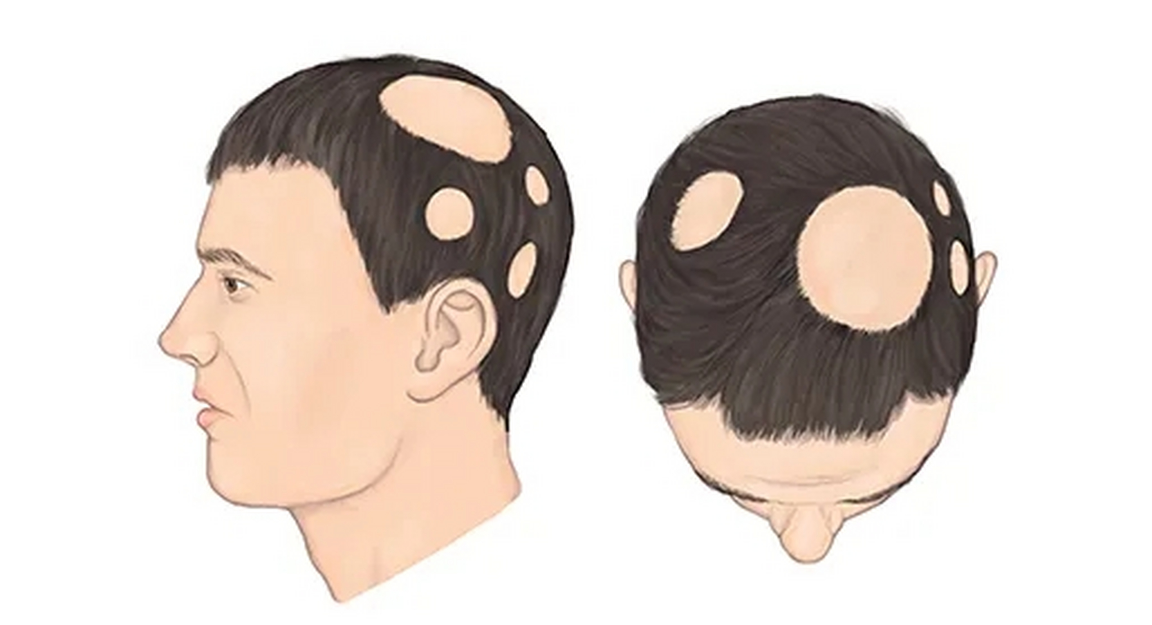 斑秃的治疗与护理#南京皮肤病研究所# #南京皮肤病研究所在线预约