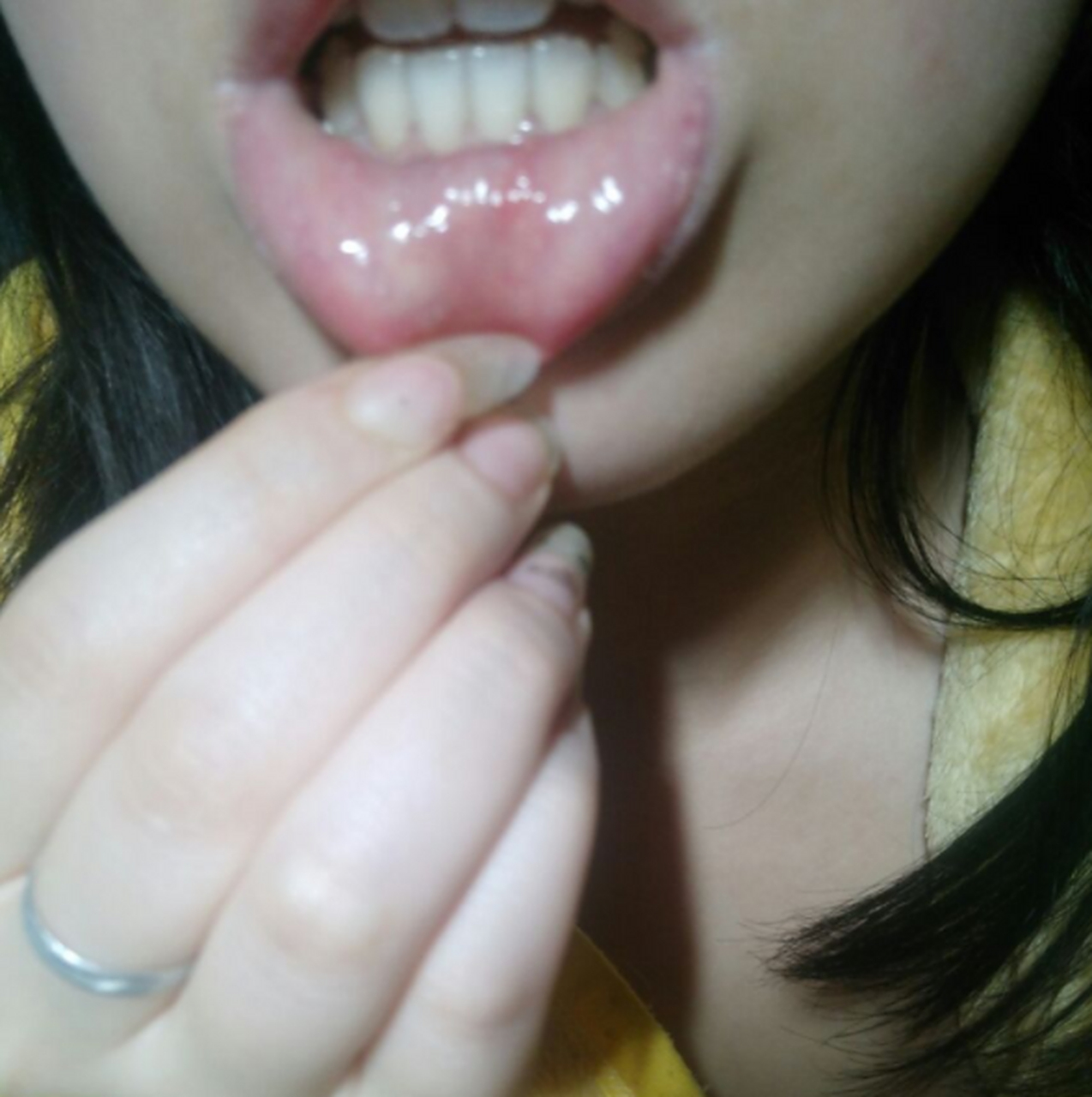 过来做检查,查出尖锐湿疣,但是最近发现下嘴唇里也……  "小菜花"学名