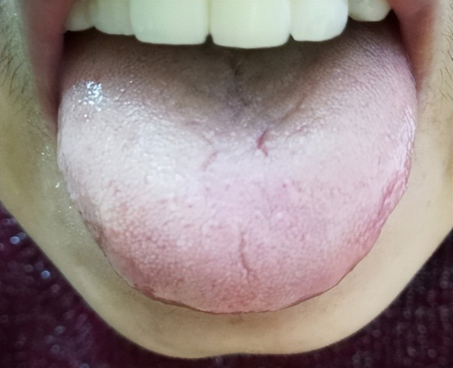 三味中药,滋阴燥湿,重拾健康  舌头在一定程度上可以反映出人体健康