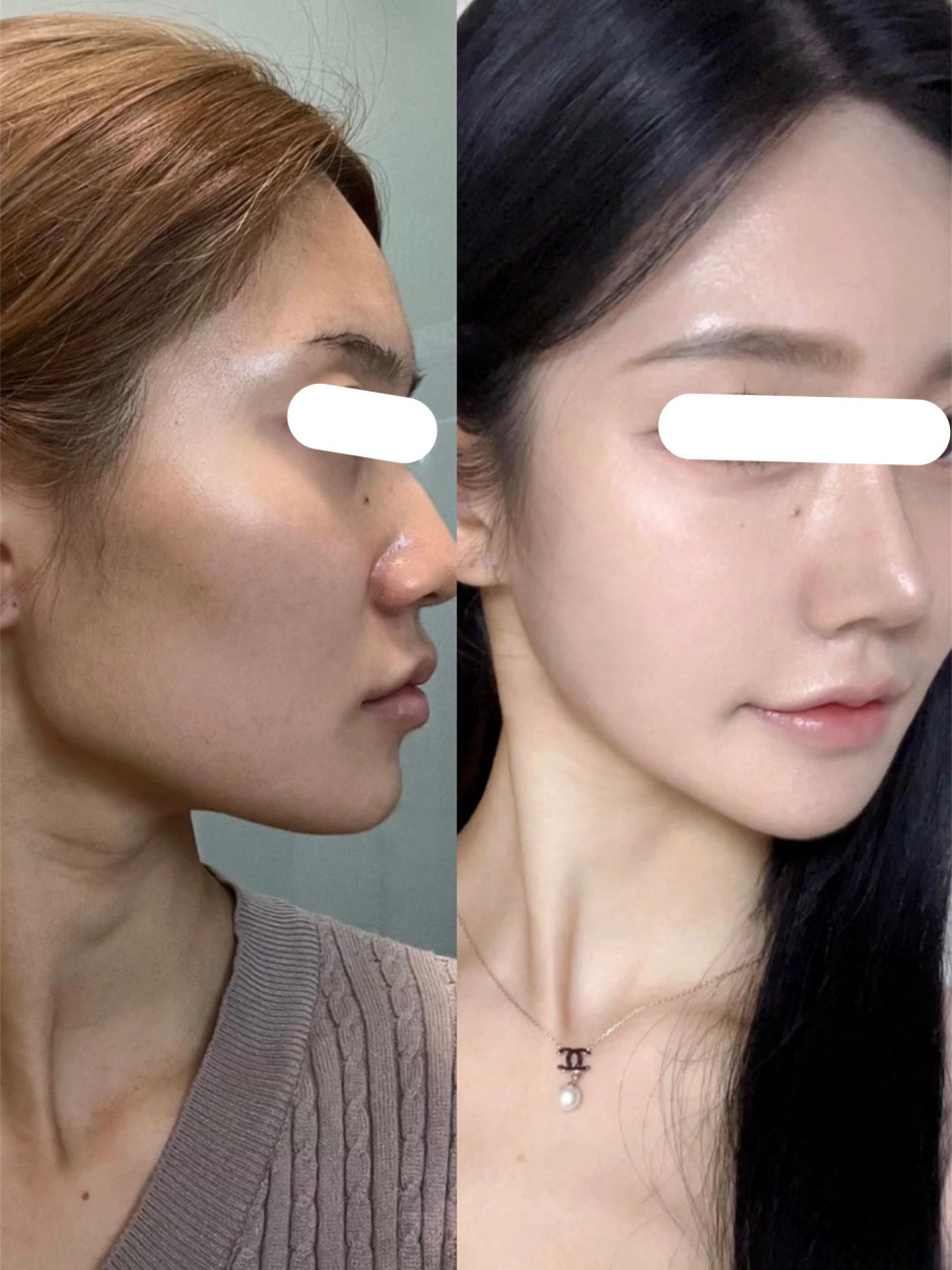 我自身脸部就是属于骨骼感特别重的类型,很多时候