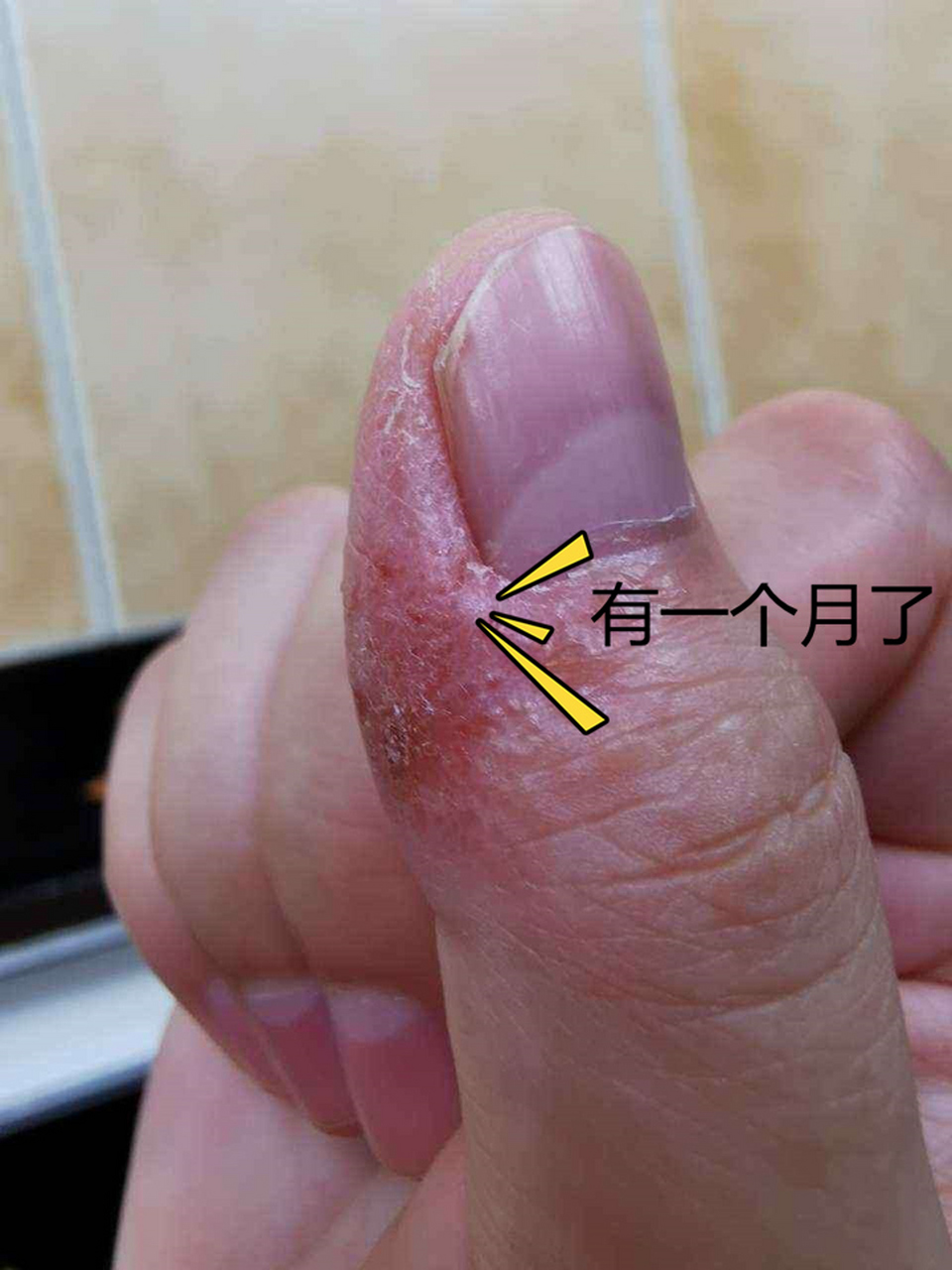 手指边长小水泡,伴有瘙痒,是汗疱疹?