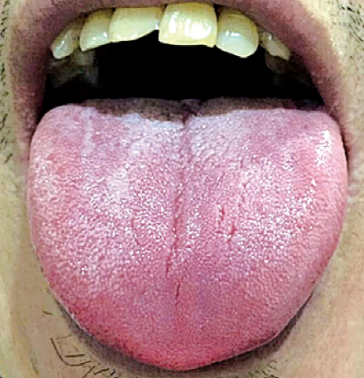 舌面无苔,养胃气很重要 这个患者是有前列腺炎,现在是胃口差,小便无力