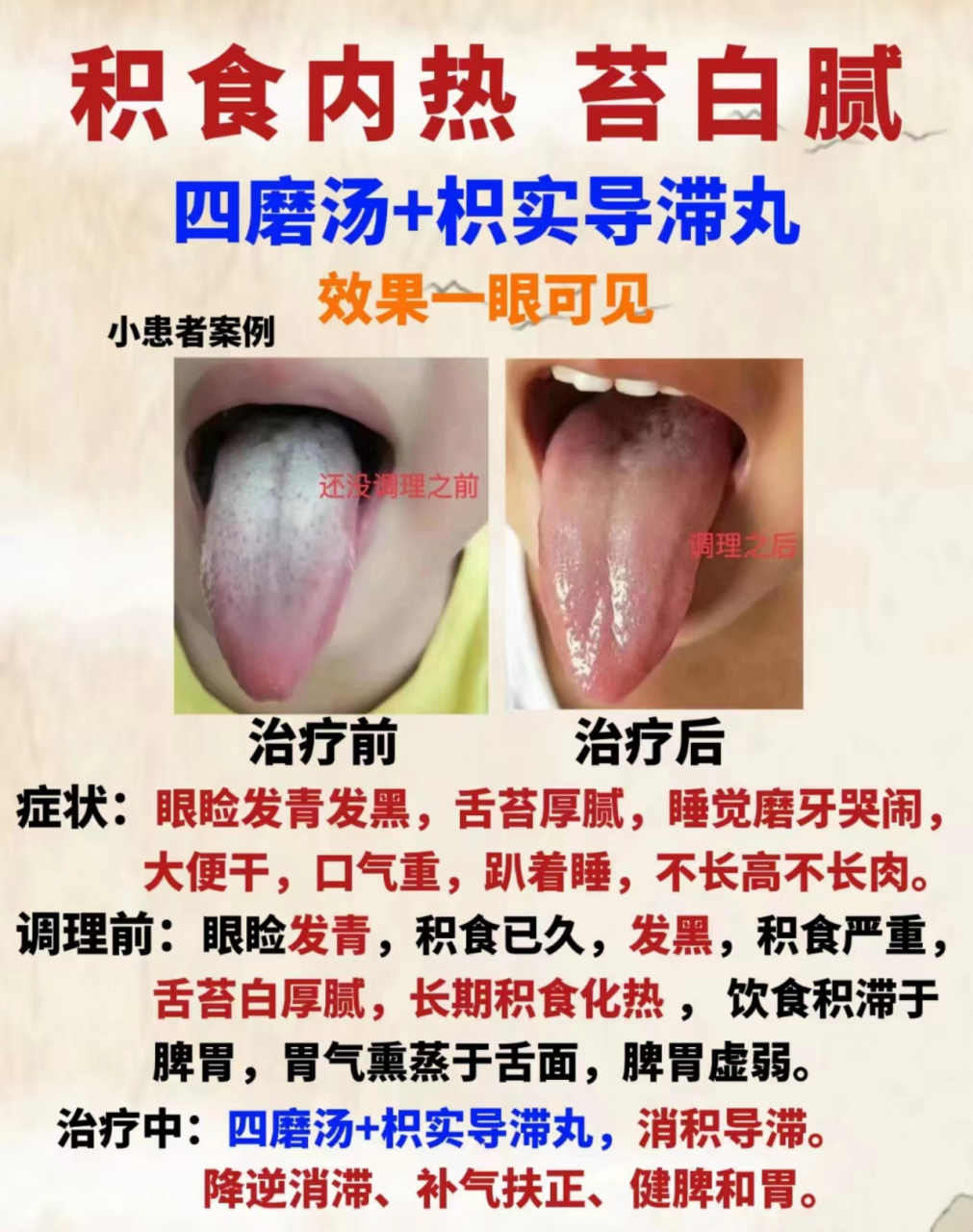 积食内热苔白腻,四磨汤 枳实导滞丸,效果一眼可见  我是湖北省中医