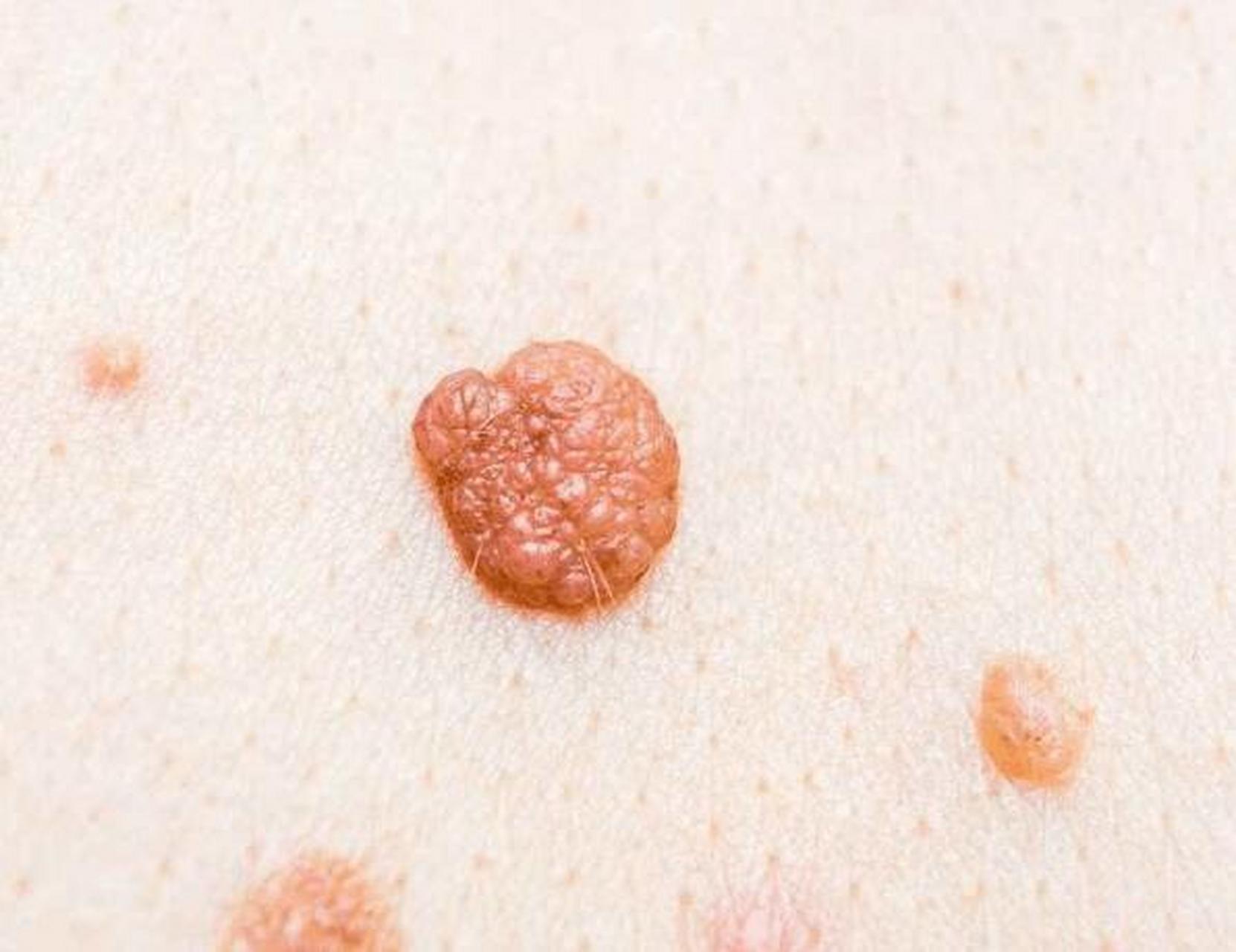 感染hpv的女人,身上会有4个"痕迹"  1,身上长疙瘩:低危型hpv感染,会