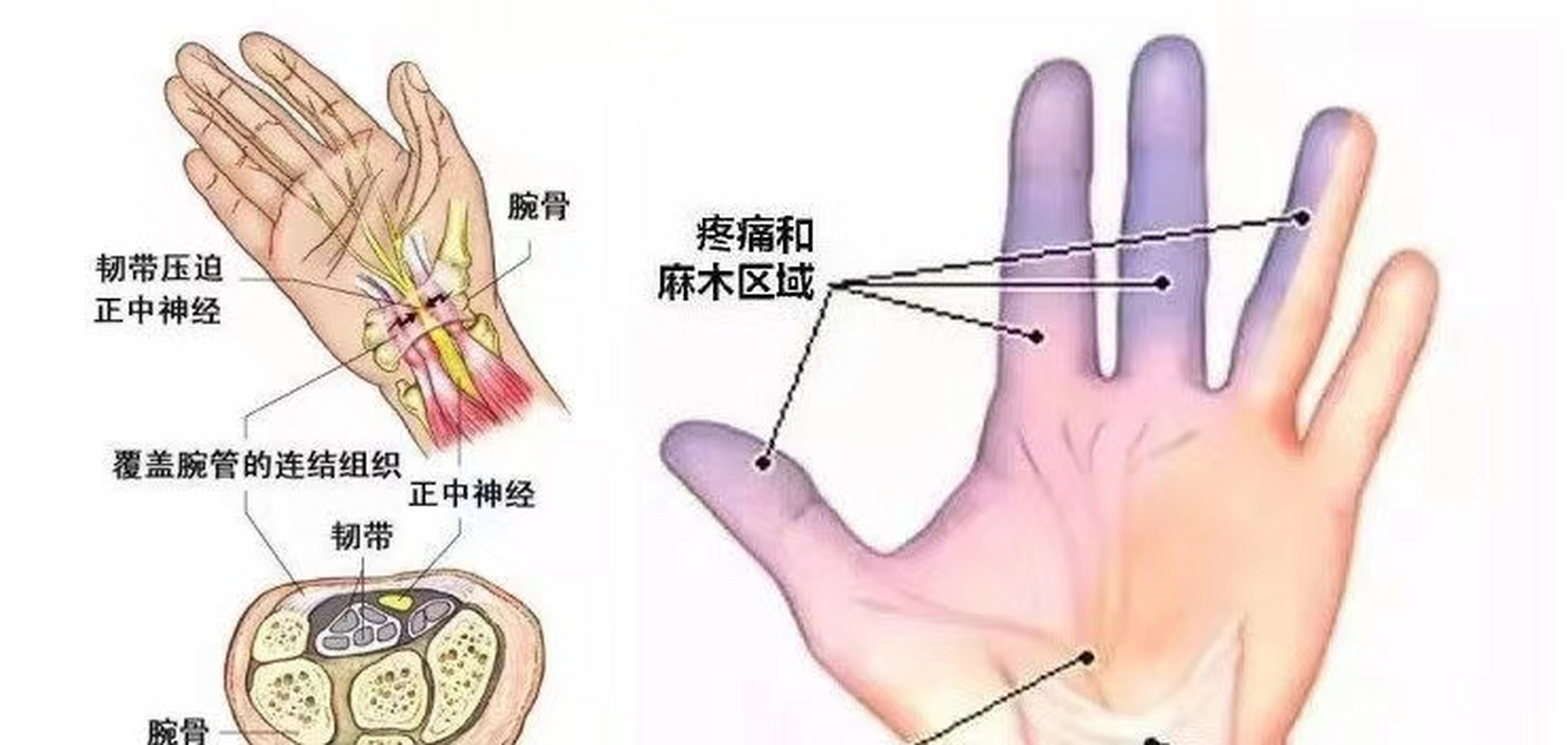 手腕腱鞘炎的位置图片图片