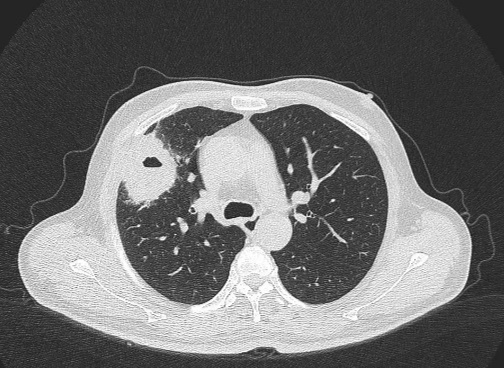 一个肺脓肿患者,差点被误诊为肺癌 这个病人50岁,咳嗽,咳痰四五天了