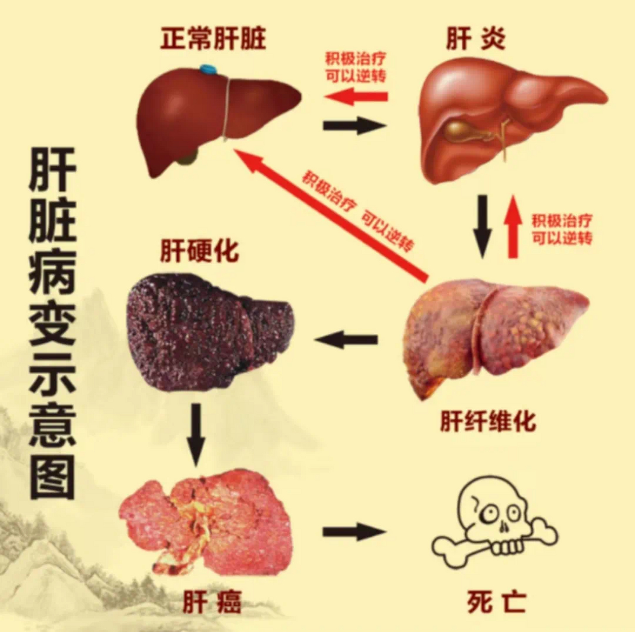 肝硬化机制图图片