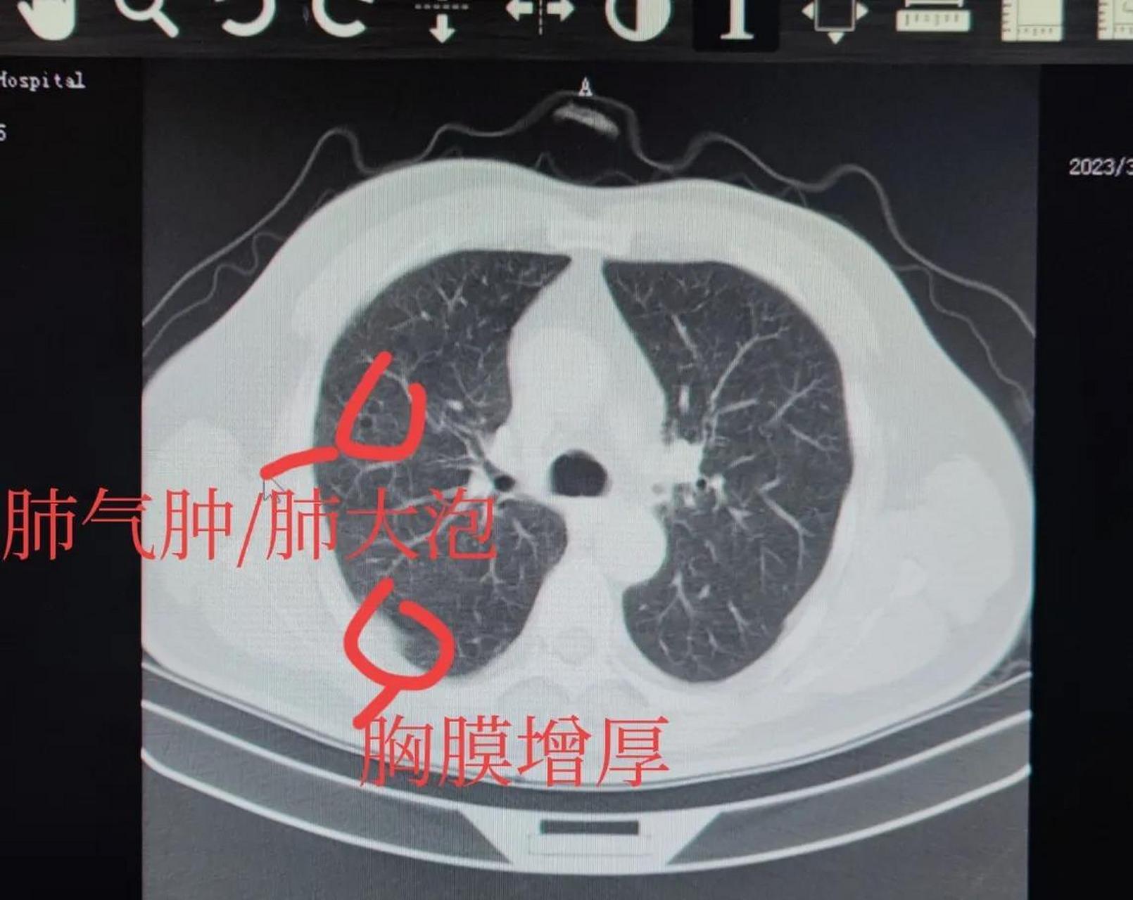 五年烟龄的肺图图片