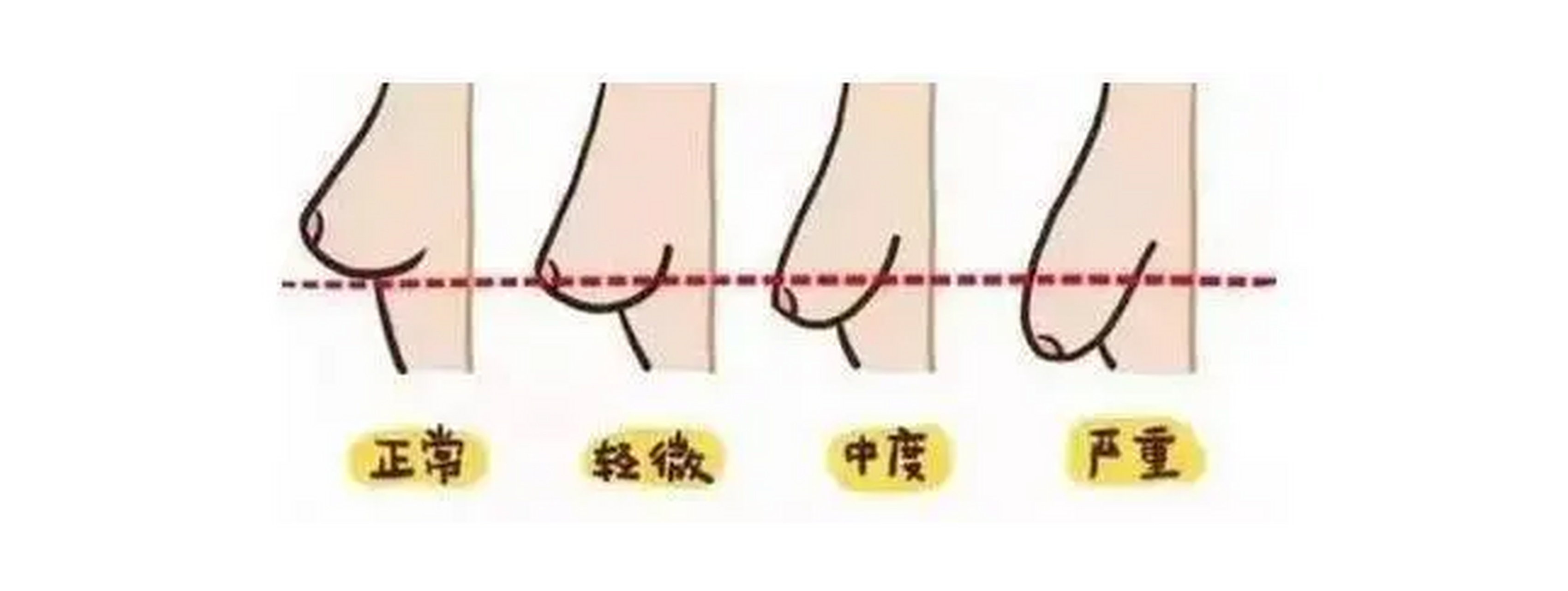 乳房成形术有助于改善畸形比例,让乳房看起来更加美观.