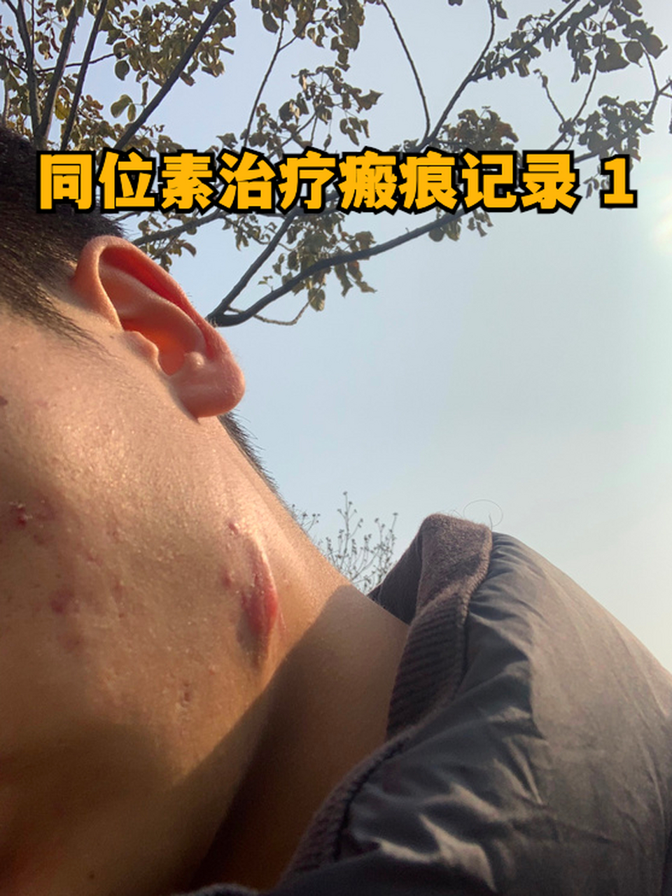 同位素治疗瘢痕记录 1 #瘢痕疙瘩#   我的瘢痕在脸部左下颌,18的时候