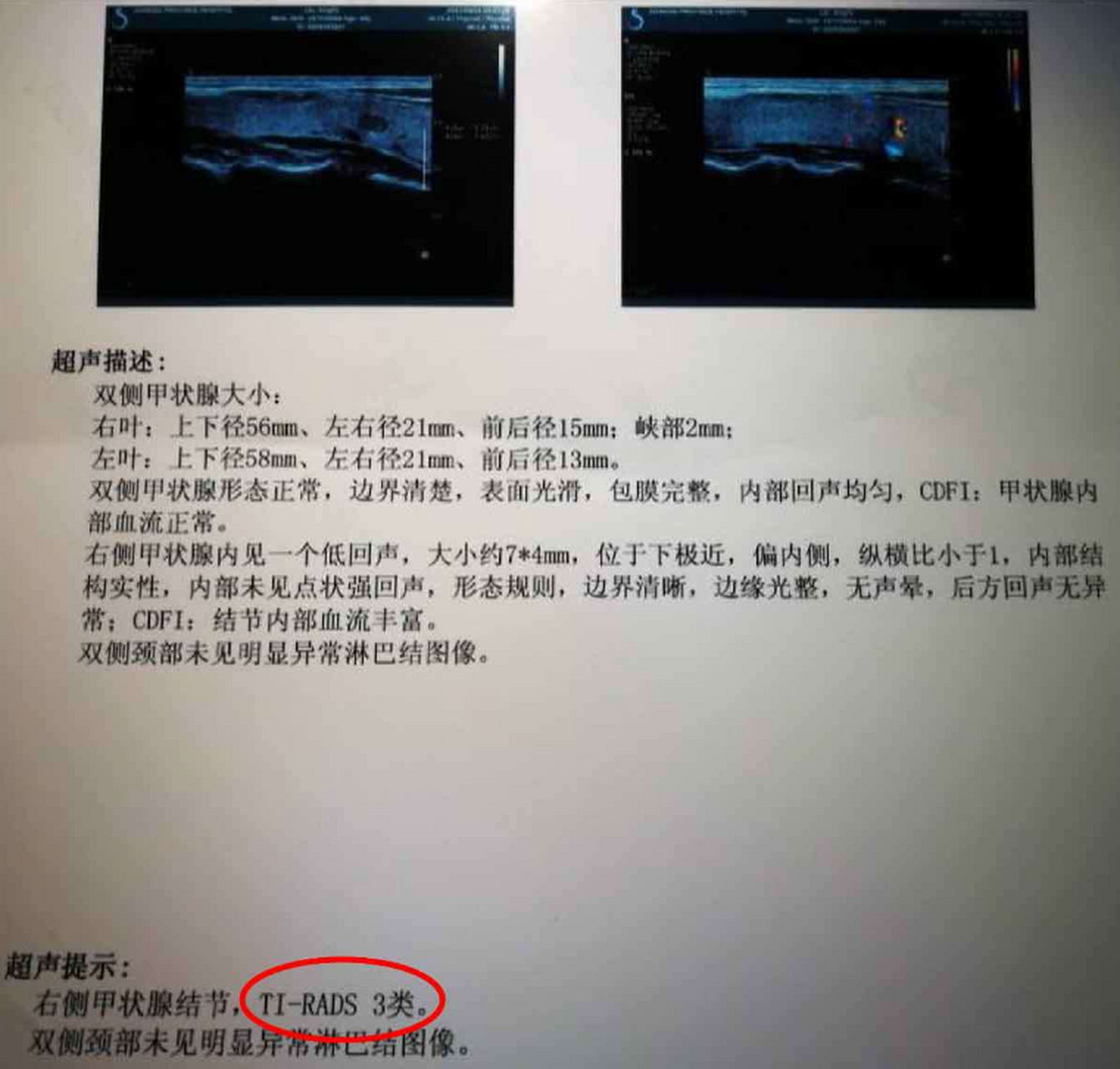 希望大家甲状腺结节彩超不要出现这些结果!  1.边界不清晰  2.