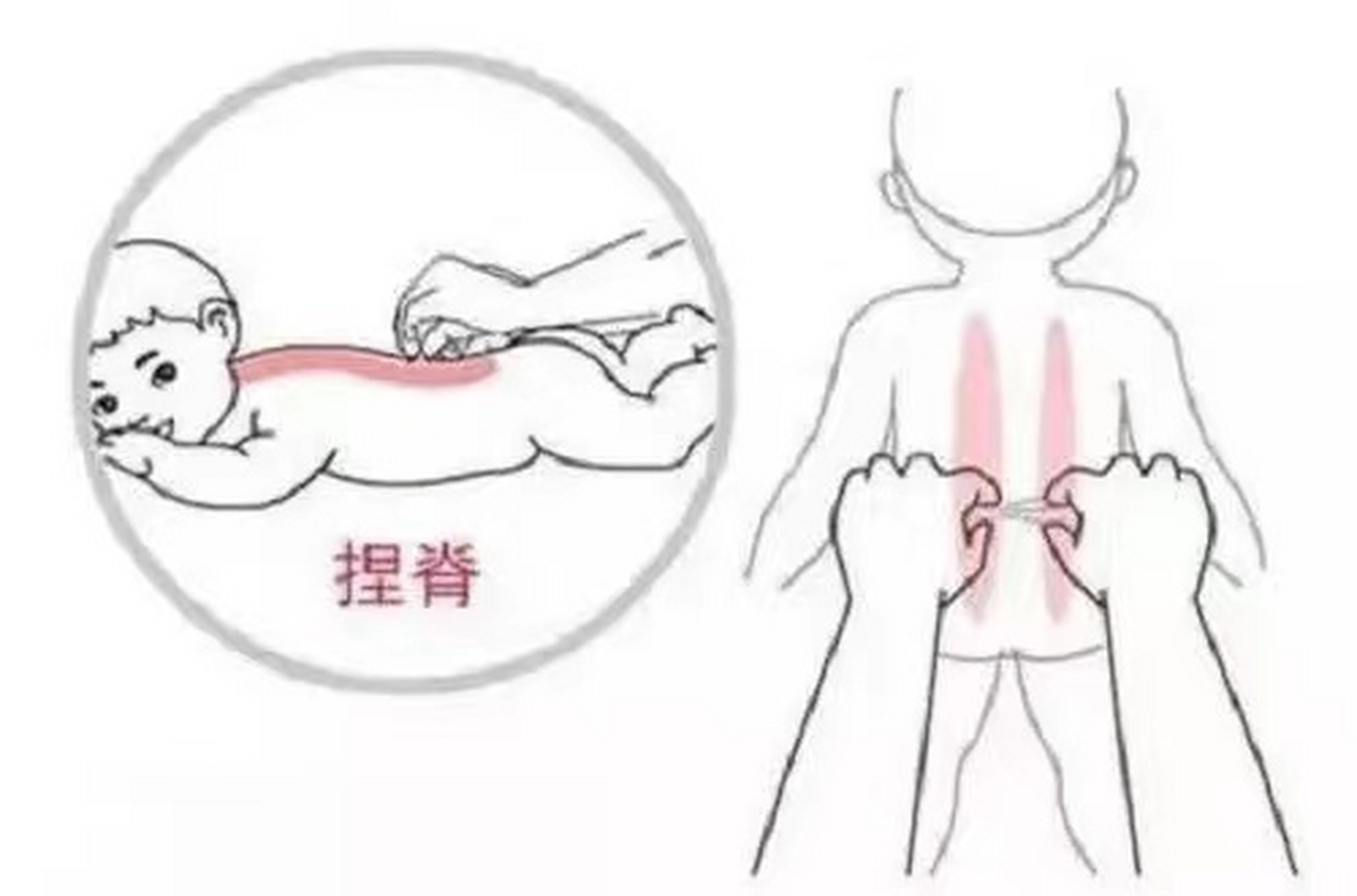 捏脊 退烧图片